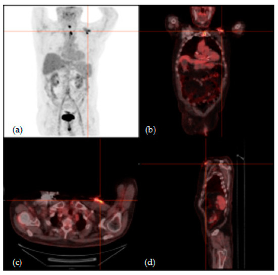Usefulness of 18F-FDG PET/CT in Patients with Cardiac Implantable ...