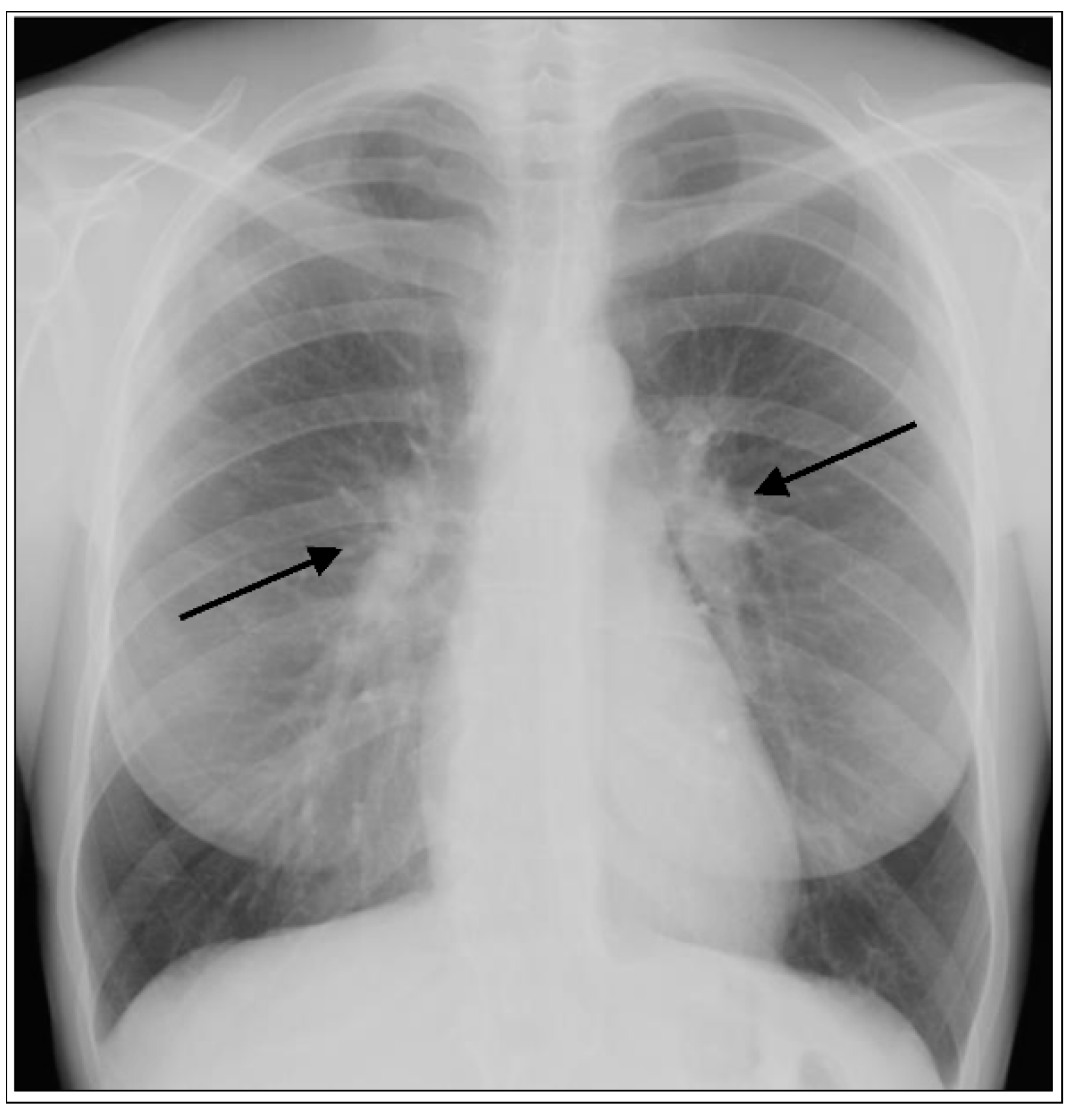 JCM Free Full-Text Clinical Presentations, Pathogenesis, and Therapy of Sarcoidosis State of the