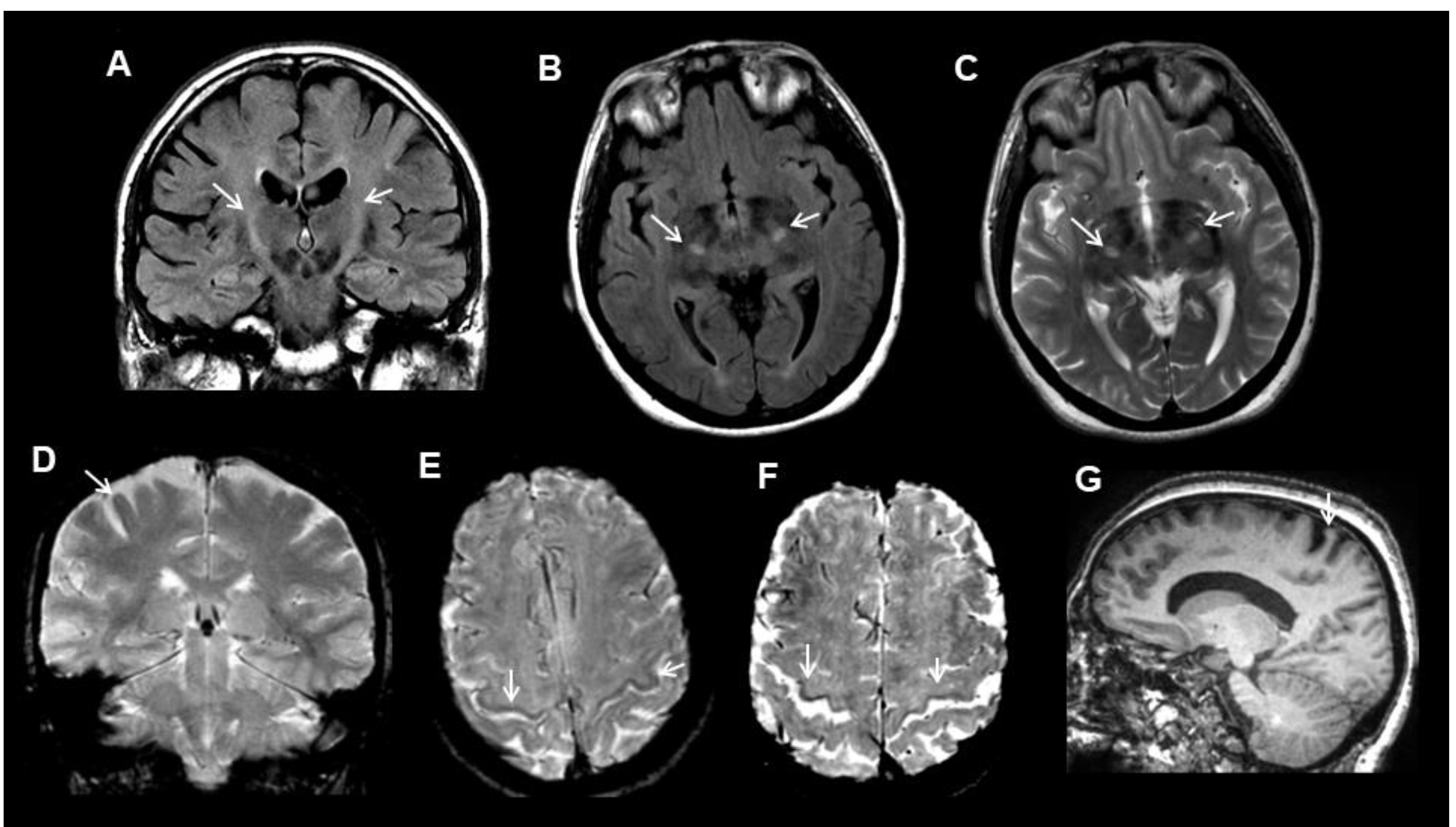 Diagnostic and Prognostic Value of Conventional Brain MRI in