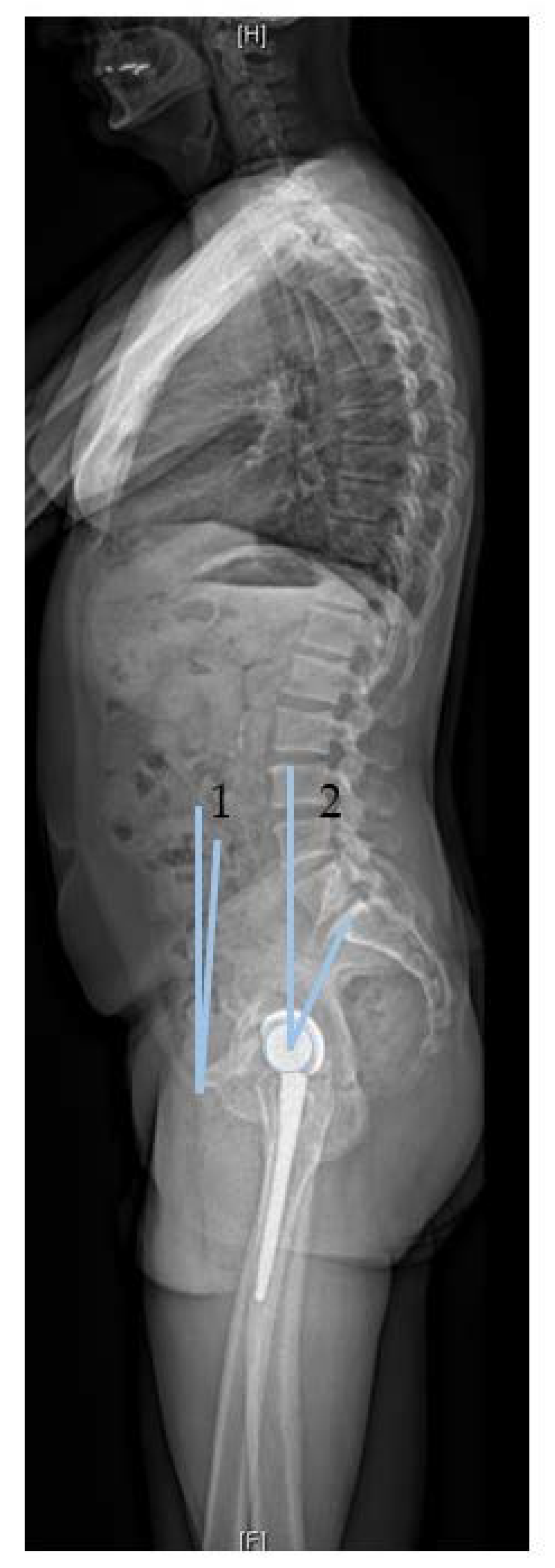 The Impact of Spinopelvic Mobility on Arthroplasty