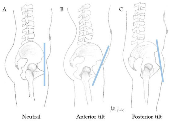 SPAT : Soutaihou-based Pelvic Adjustmen… The Impact of Spinopelvic Mobility on Arthroplasty