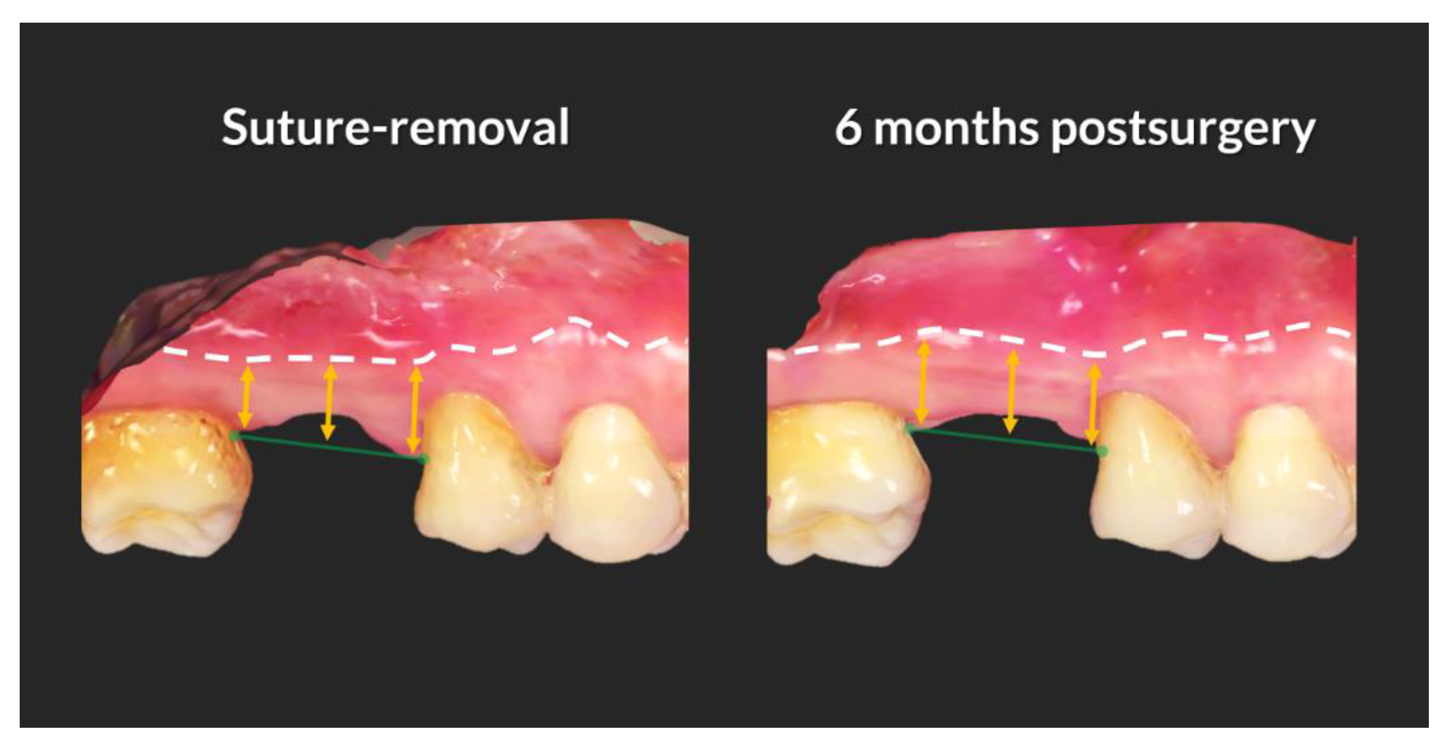 Jcm Free Full Text Soft Tissue Dimensions Following Tooth Extraction In The Posterior Maxilla A Randomized Clinical Trial Comparing Alveolar Ridge Preservation To Spontaneous Healing Html