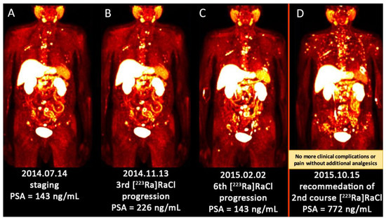 Targeted Palliative Radionuclide Therapy for Metastatic Bone Pain