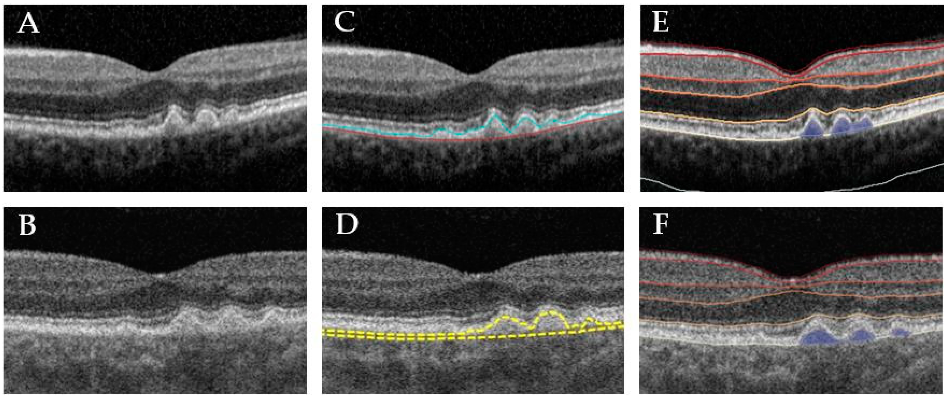JCM | Free Full-Text | Comparison of Drusen Volume Assessed by Two  Different OCT Devices