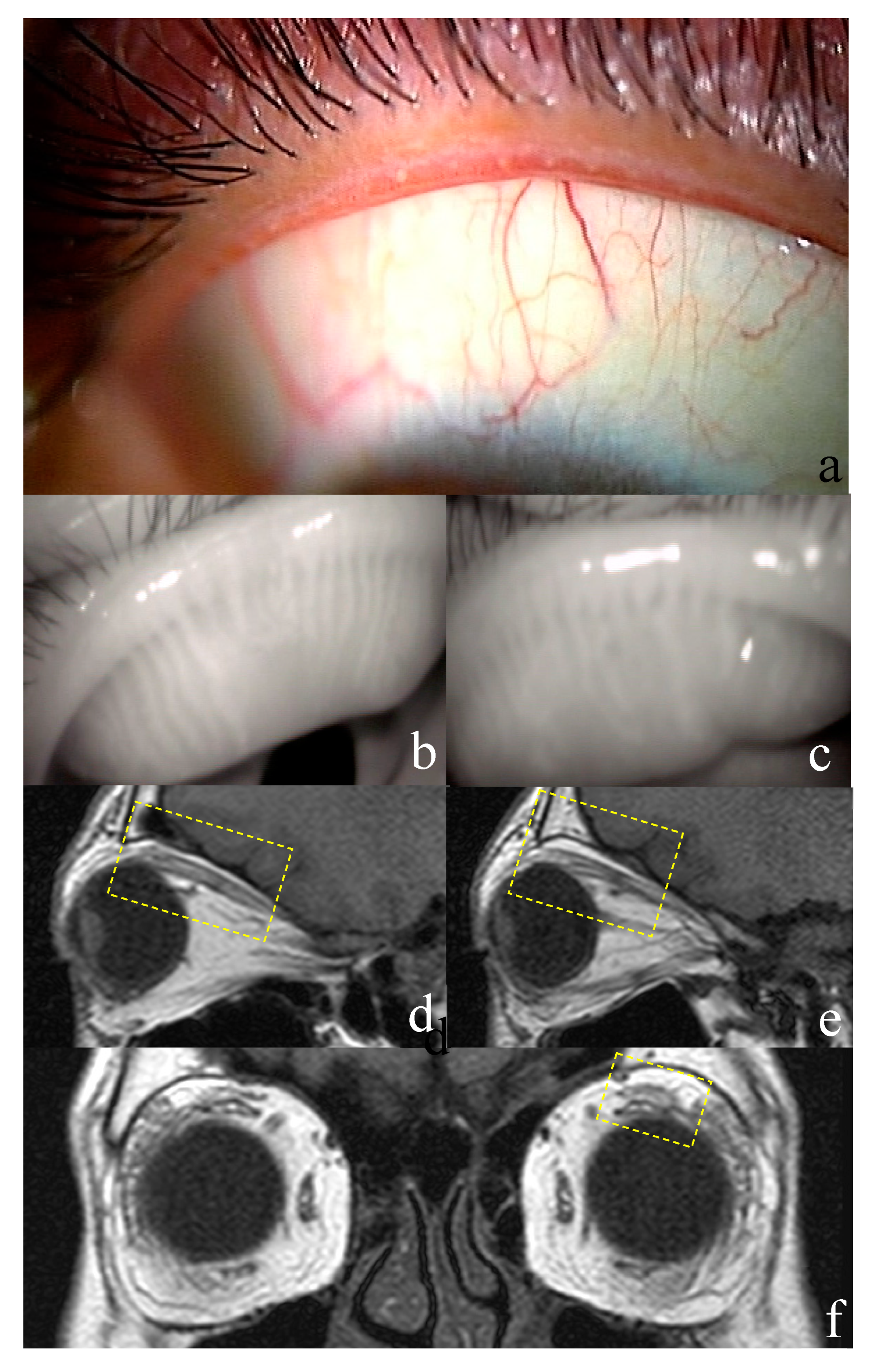 JCM Free Full-Text Investigation of Meibomian Gland Function and Dry Eye Disease in Patients with Graves Ophthalmopathy