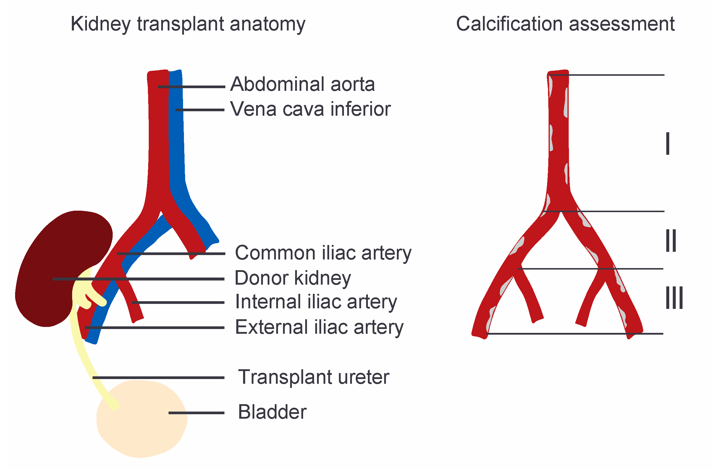 JCM   Free Full Text   Aorto Iliac Artery Calcification Prior to ...