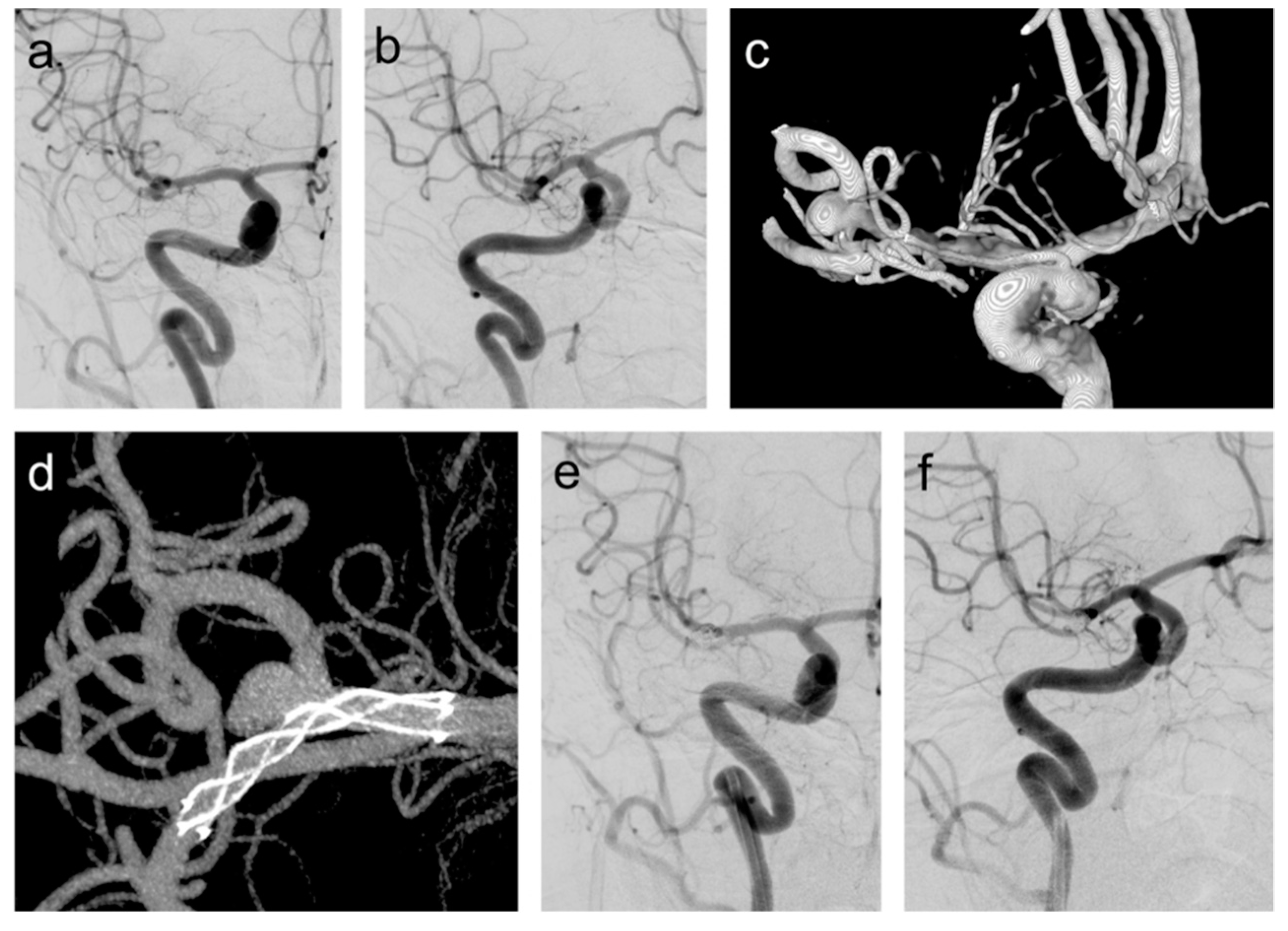 JCM Free FullText StentAssisted Coiling of Unruptured MCA Aneurysms Using the LVIS Jr