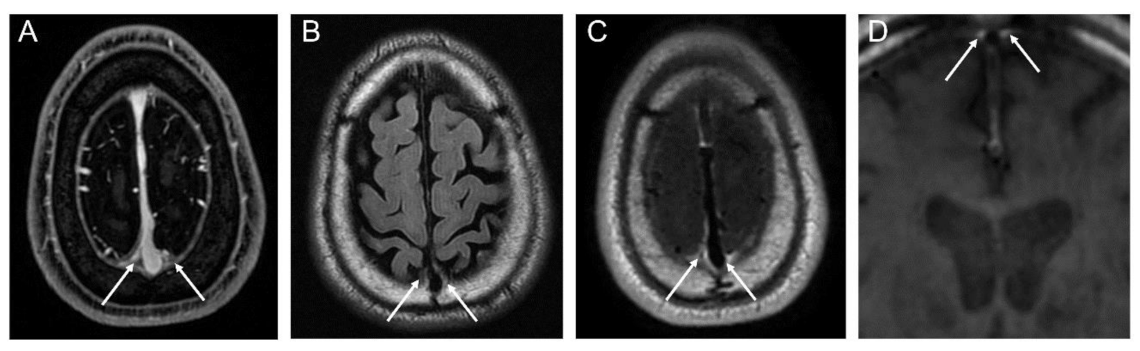 T1 weighted mri blood