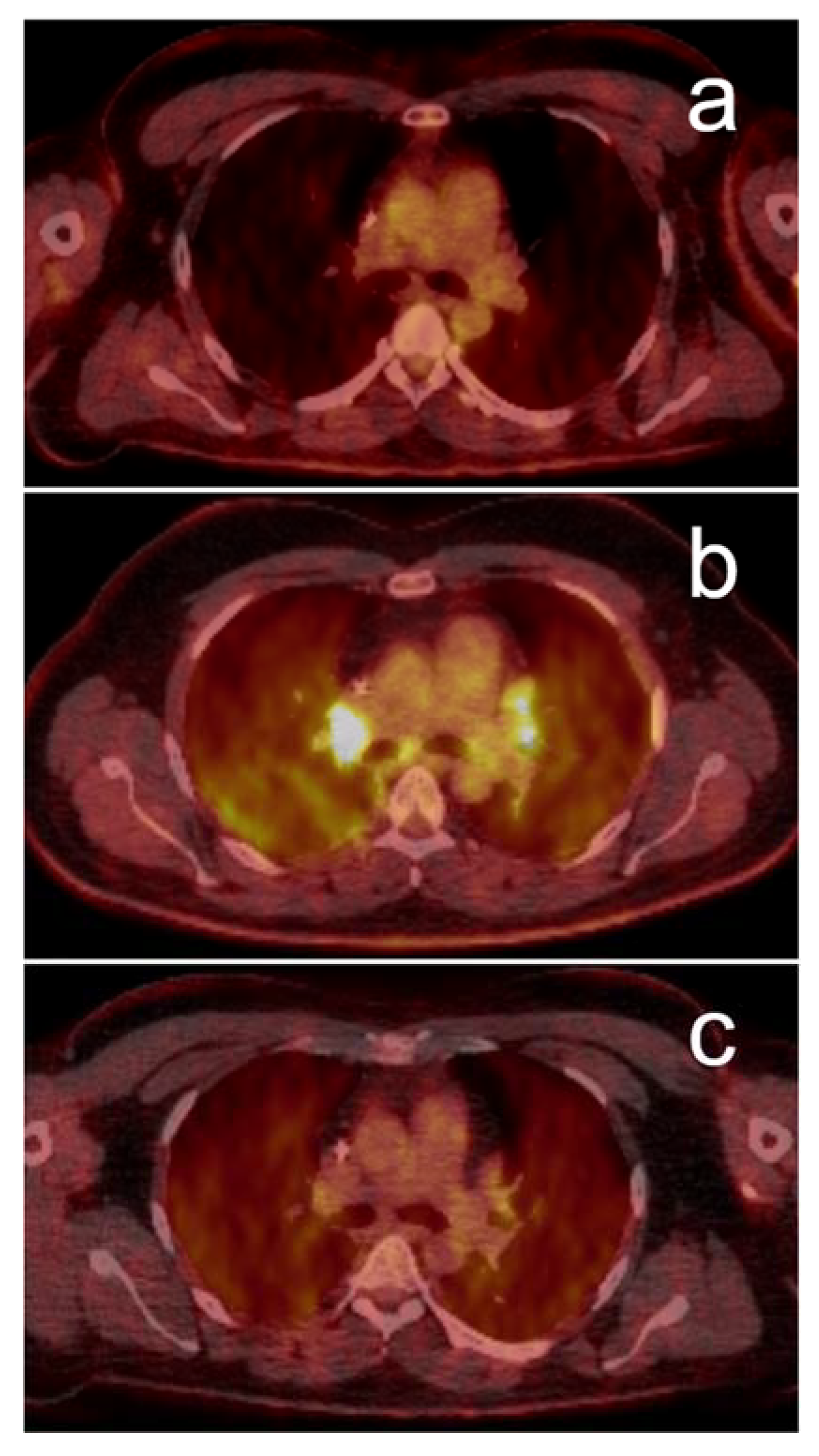 fda approval mesothelioma