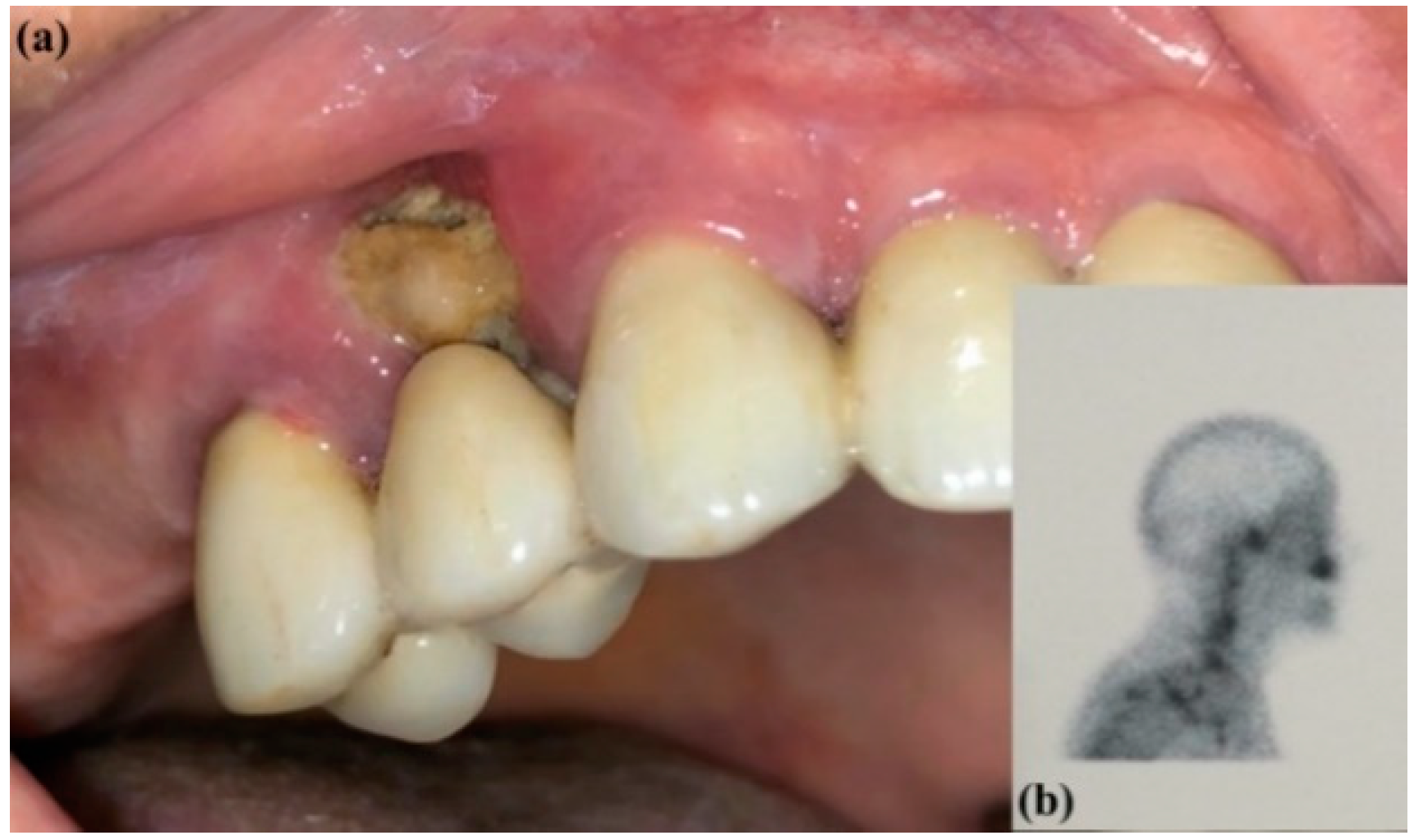 JCM Free FullText Management of MedicationRelated Osteonecrosis
