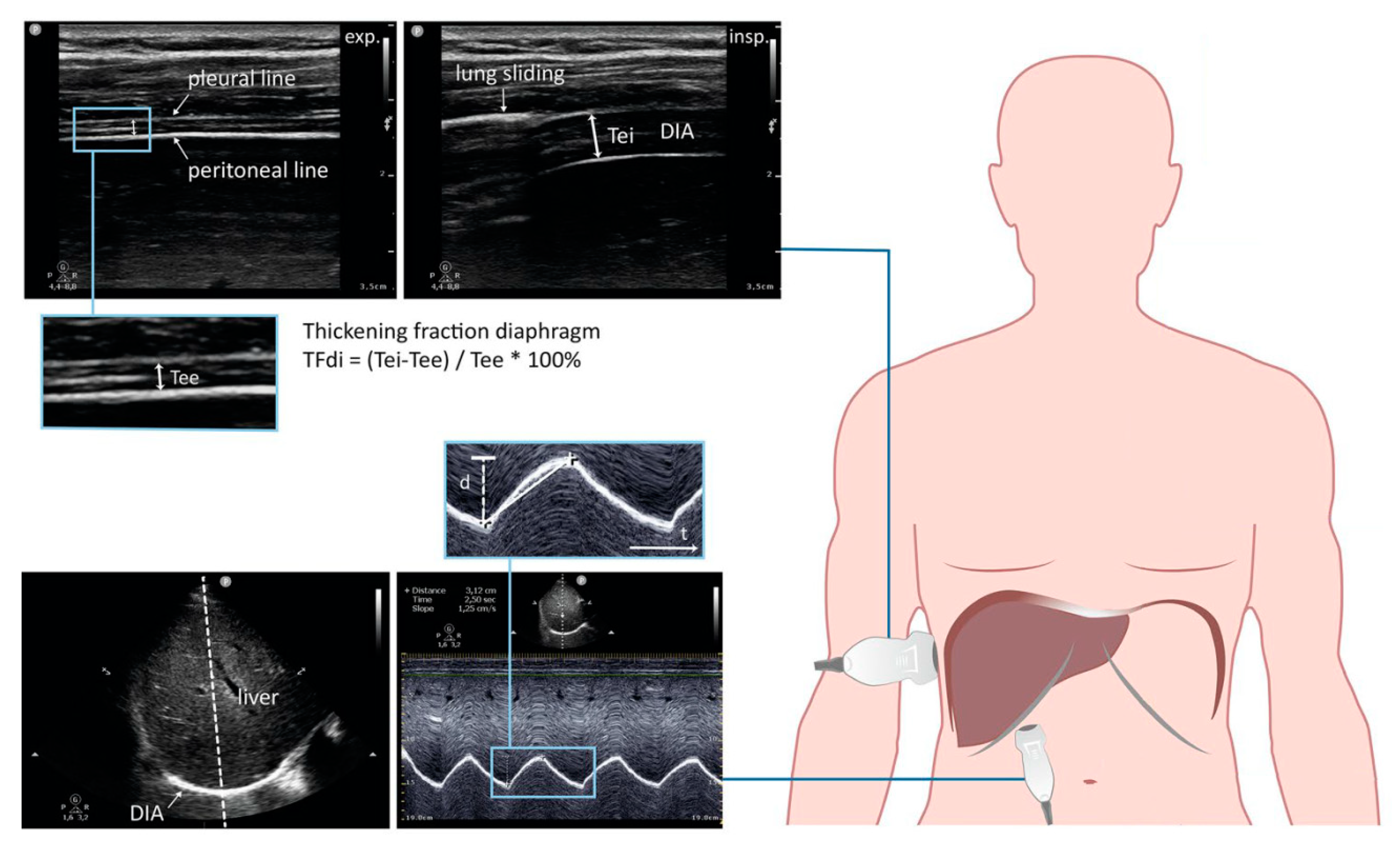 JCM Free FullText The Use of Diaphragm Ultrasonography in