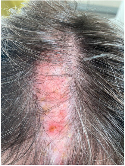 Pityriasis Amiantacea - Treatment Of Pityriasis Amiantacea With Infliximab : Check spelling or type a new query.
