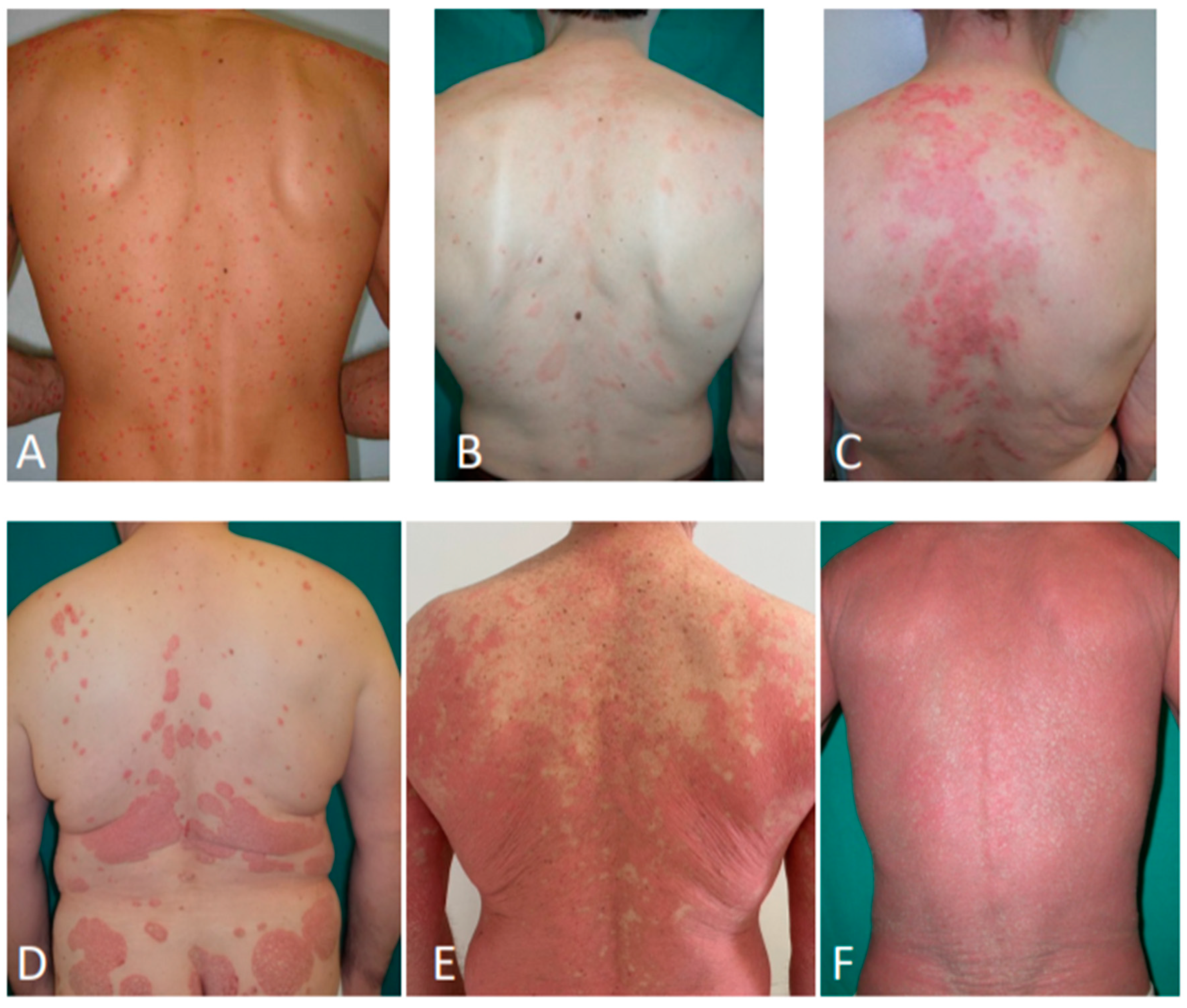 Tinea Capitis Often Overlooked in Adults - Advances in Dermatology