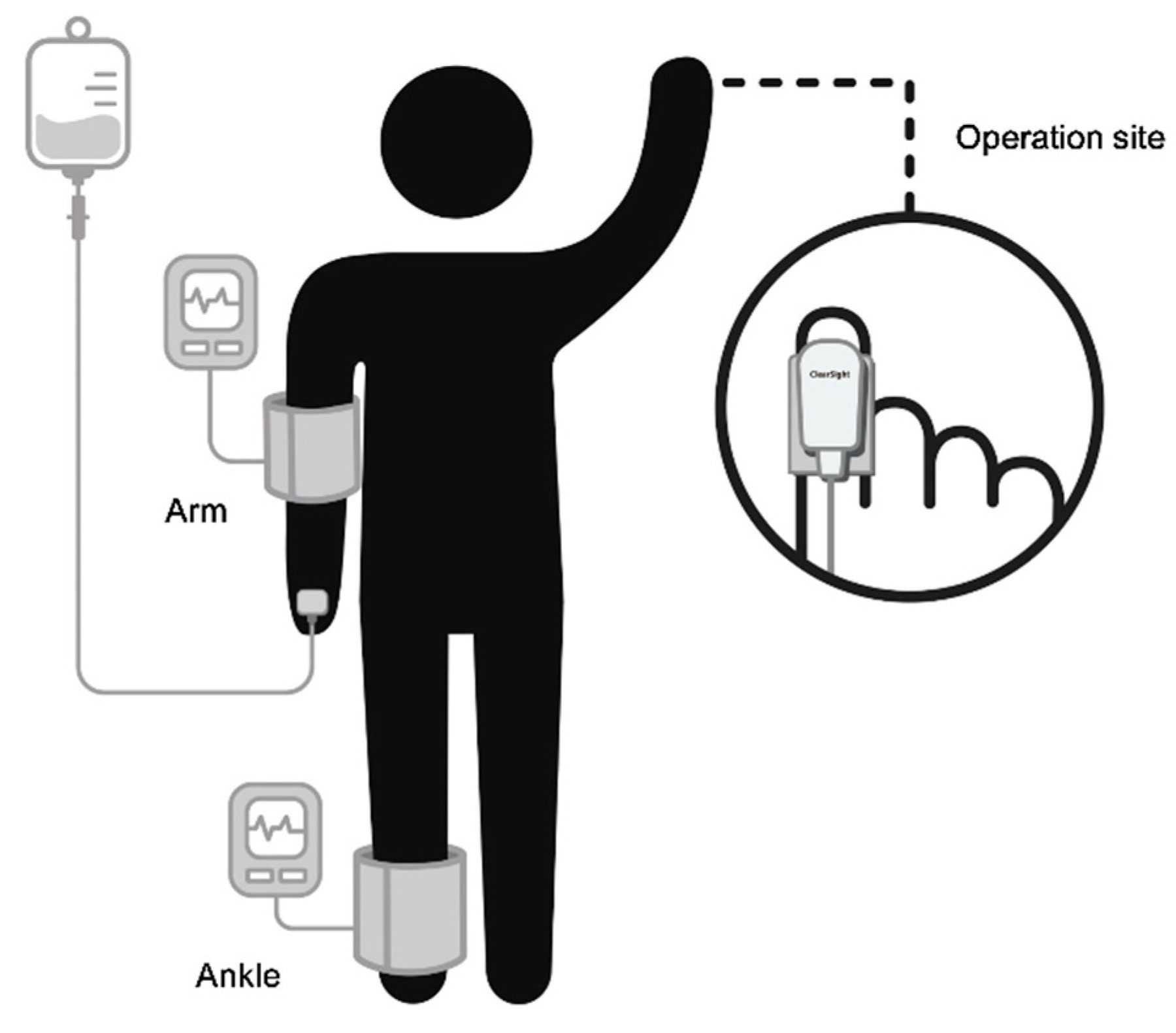 Continuous NonInvasive Arterial Pressure Monitoring (ClearSight System