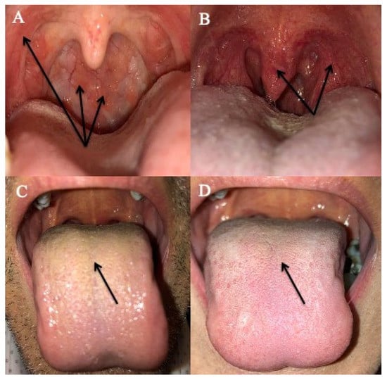 JCM | Free Full-Text | Laryngopharyngeal Reflux: A State-of-the-Art