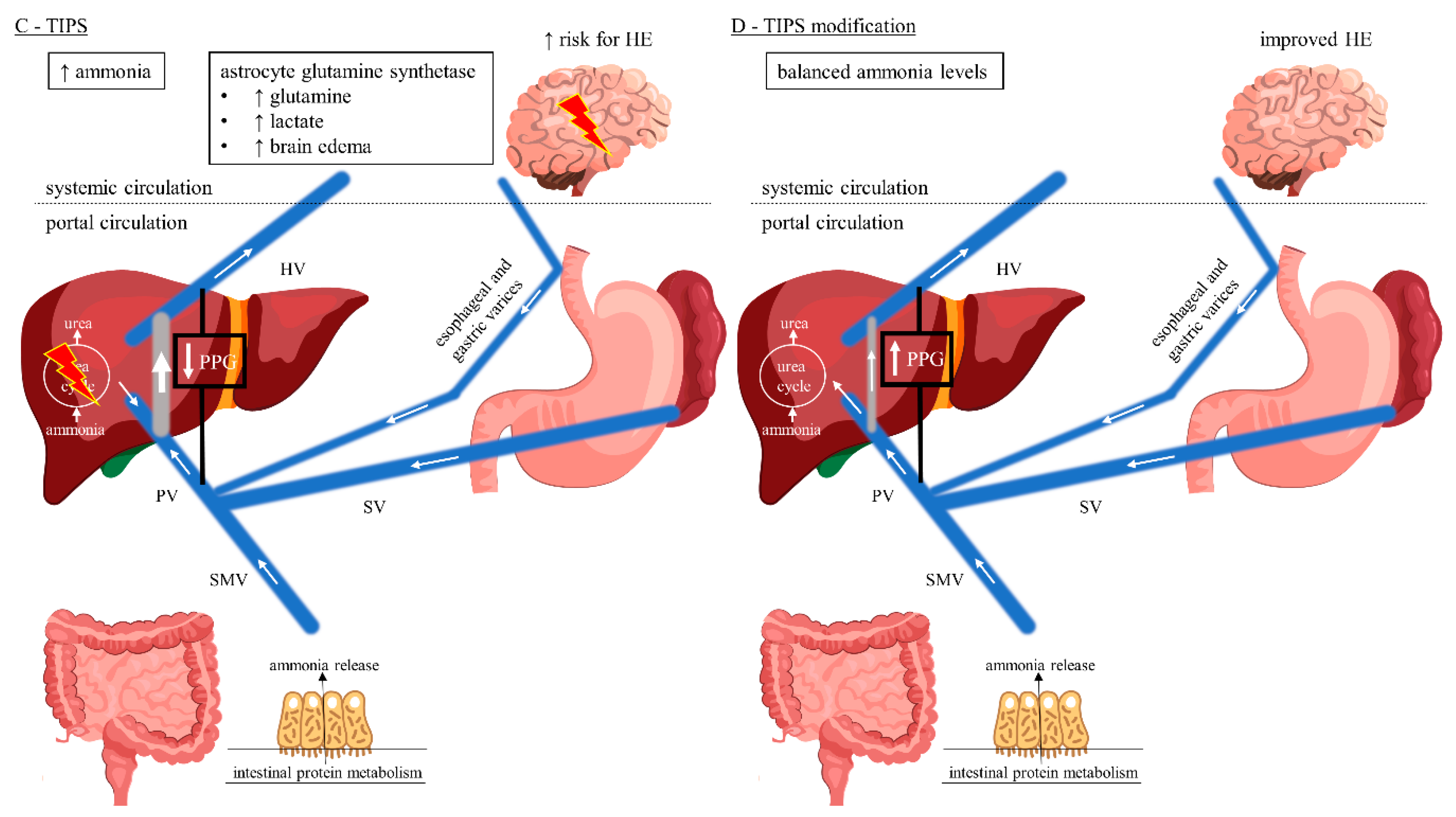 Transjugular Intrahepatic Portosystemic Shunt Diagram