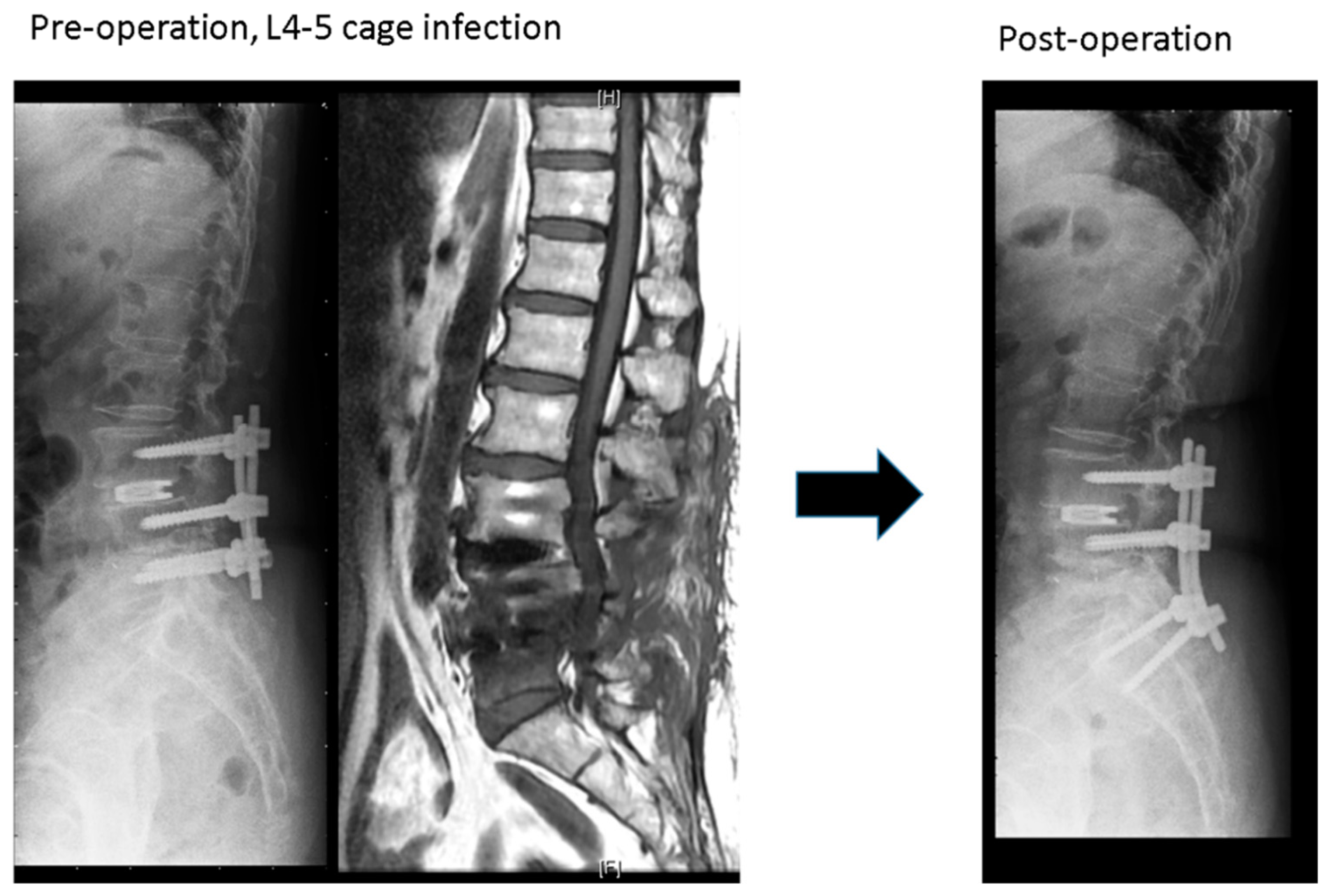 Jcm | Free Full-Text | Revision Surgery For Postoperative Spondylodiscitis  At Cage Level After Posterior Instrumented Fusion In The Lumbar  Spine—Anterior Approach Is Not Absolutely Indicated | Html