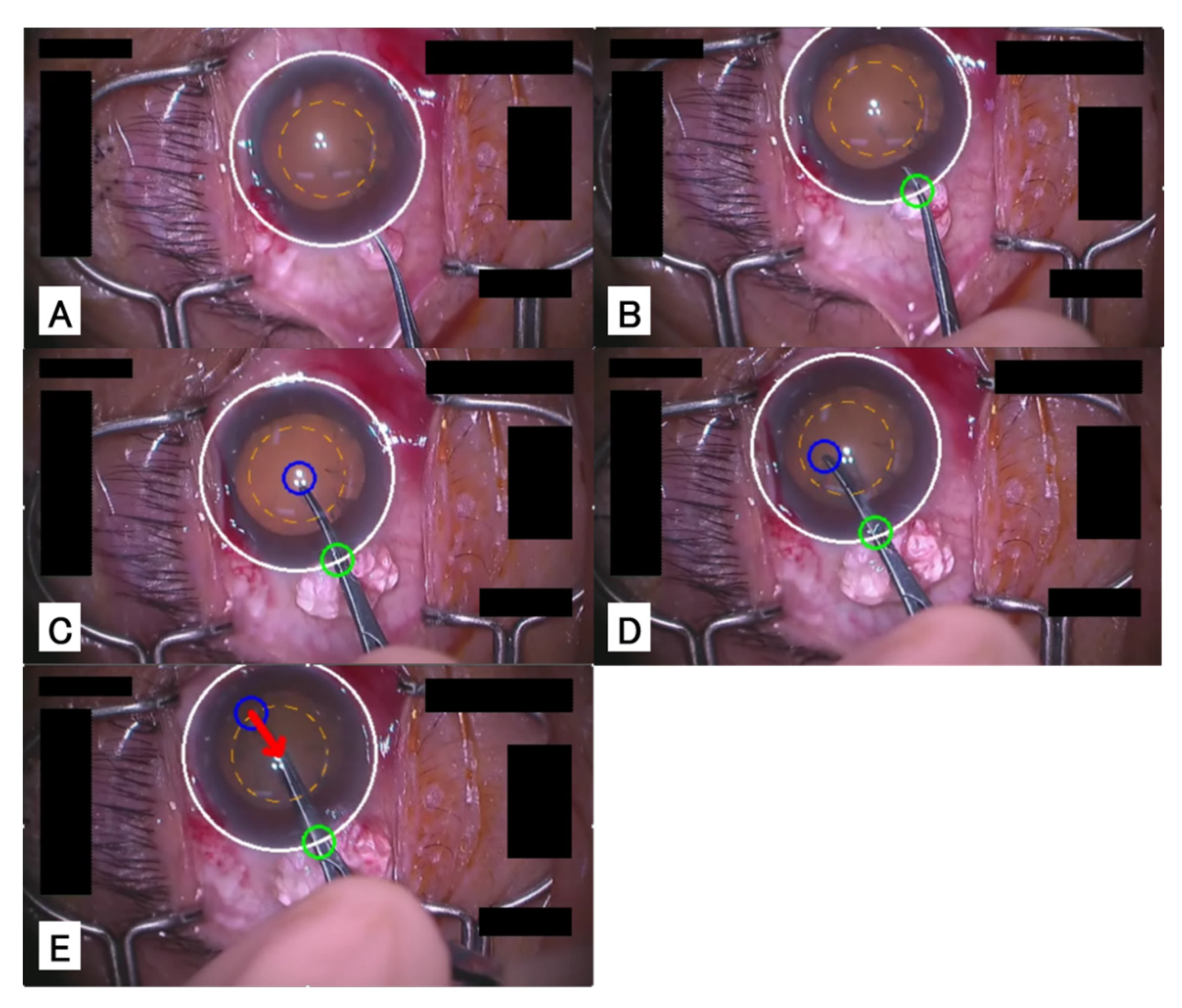 Jcm Free Full Text Real Time Surgical Problem Detection And Instrument Tracking In Cataract Surgery Html