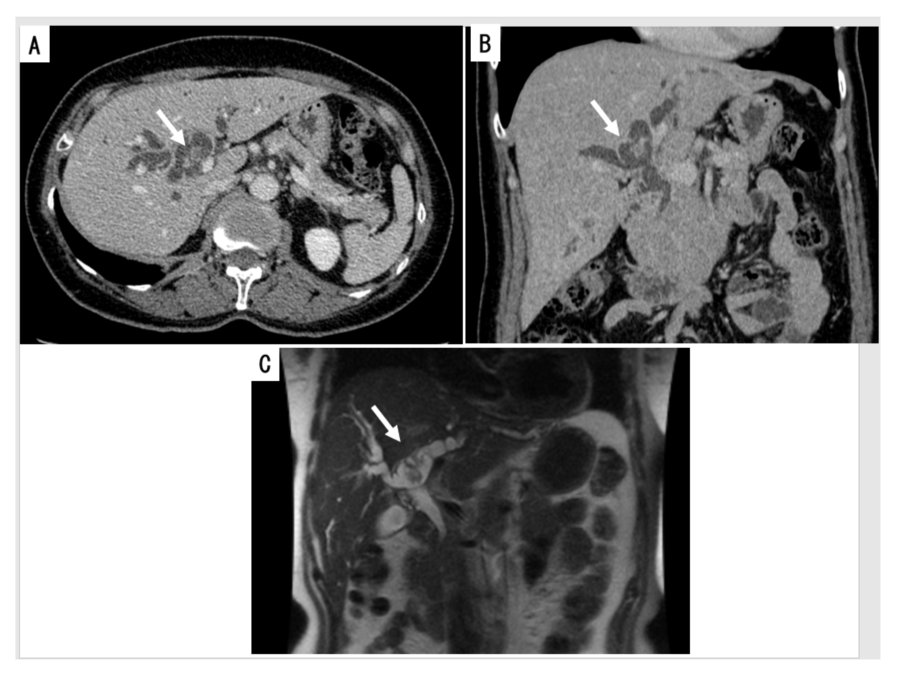 intraductal papilloma bile duct