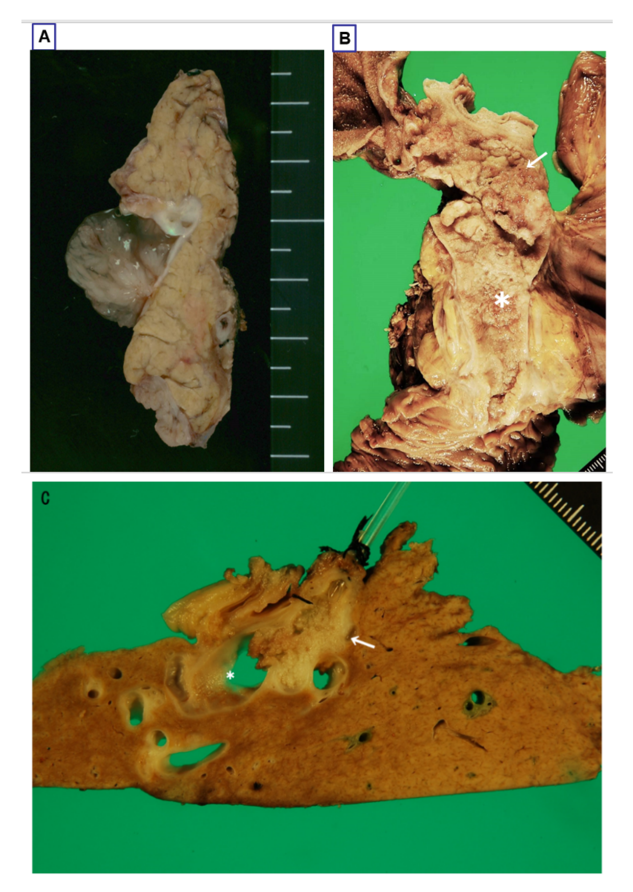 biliary papillomatosis intraductal papillary mucinous neoplasm