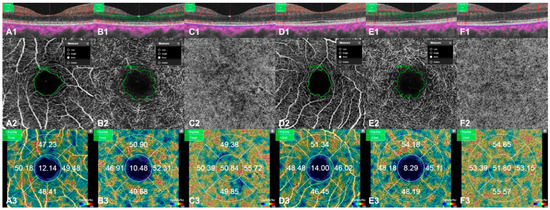 Comparison of Retinal Layer Thickness and Capillary Vessel Density in ...