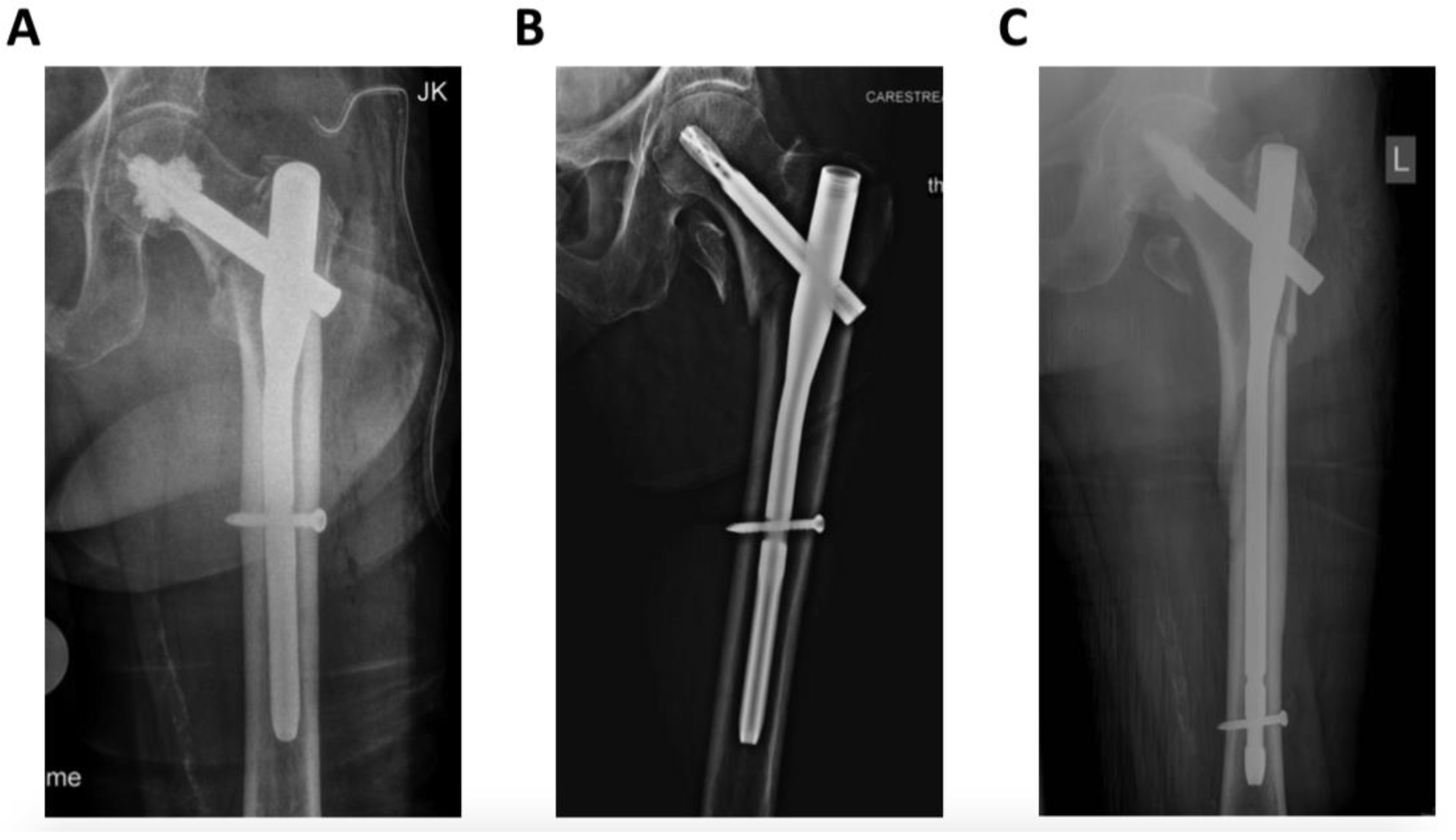 A Comparative Study, Proximal Femoral Nailing(PFN) and Dynamic Hip  Screw(DHS) in Intertrochanteric Fracture Femur. | Semantic Scholar