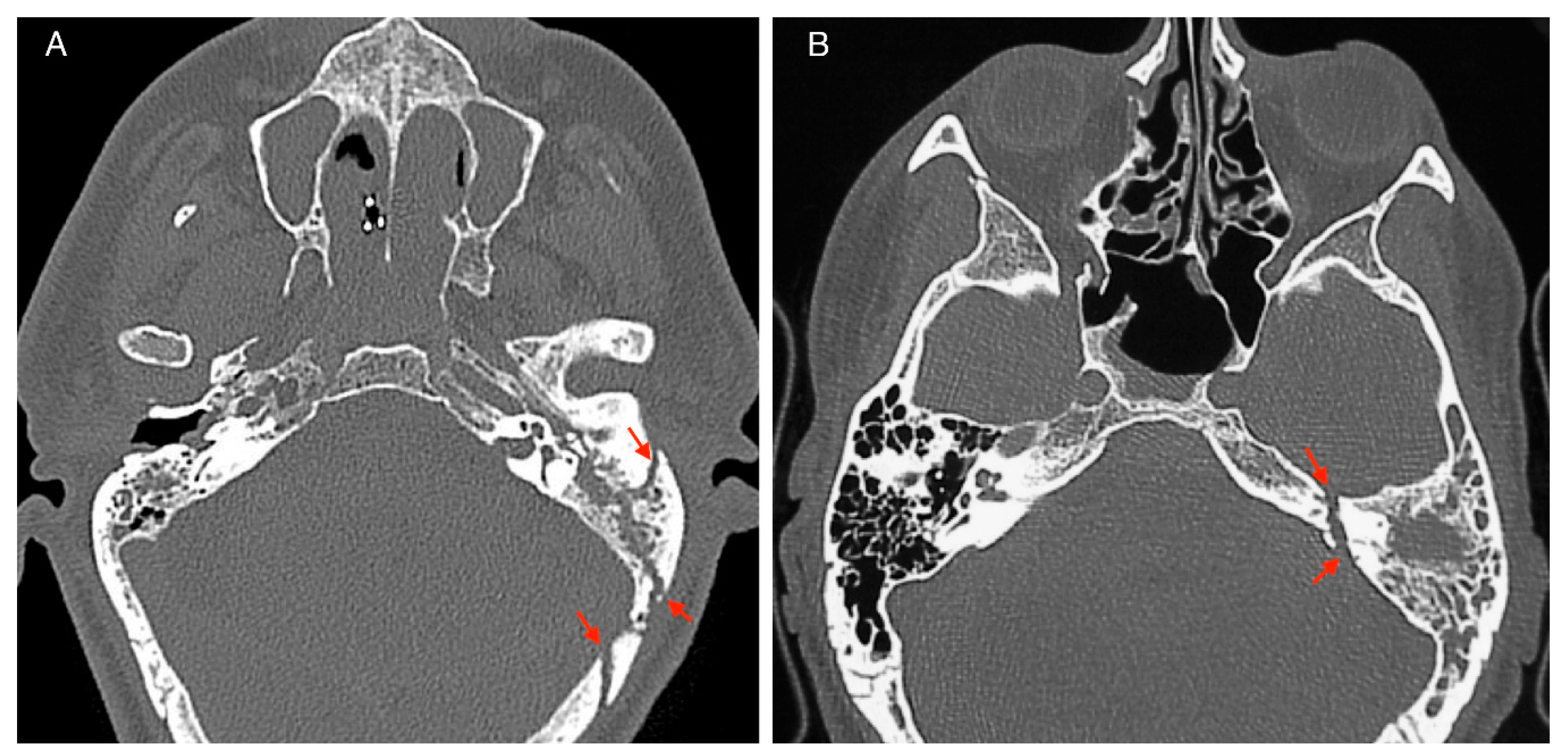 Petrous Temporal Bone Fracture