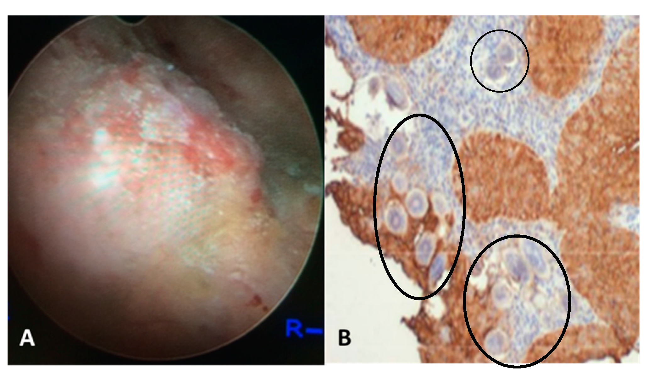 Schistosomiasis nedir Schistosomiasis slideshare. Cancers caused by hpv 16, Schistosomiasis nedir