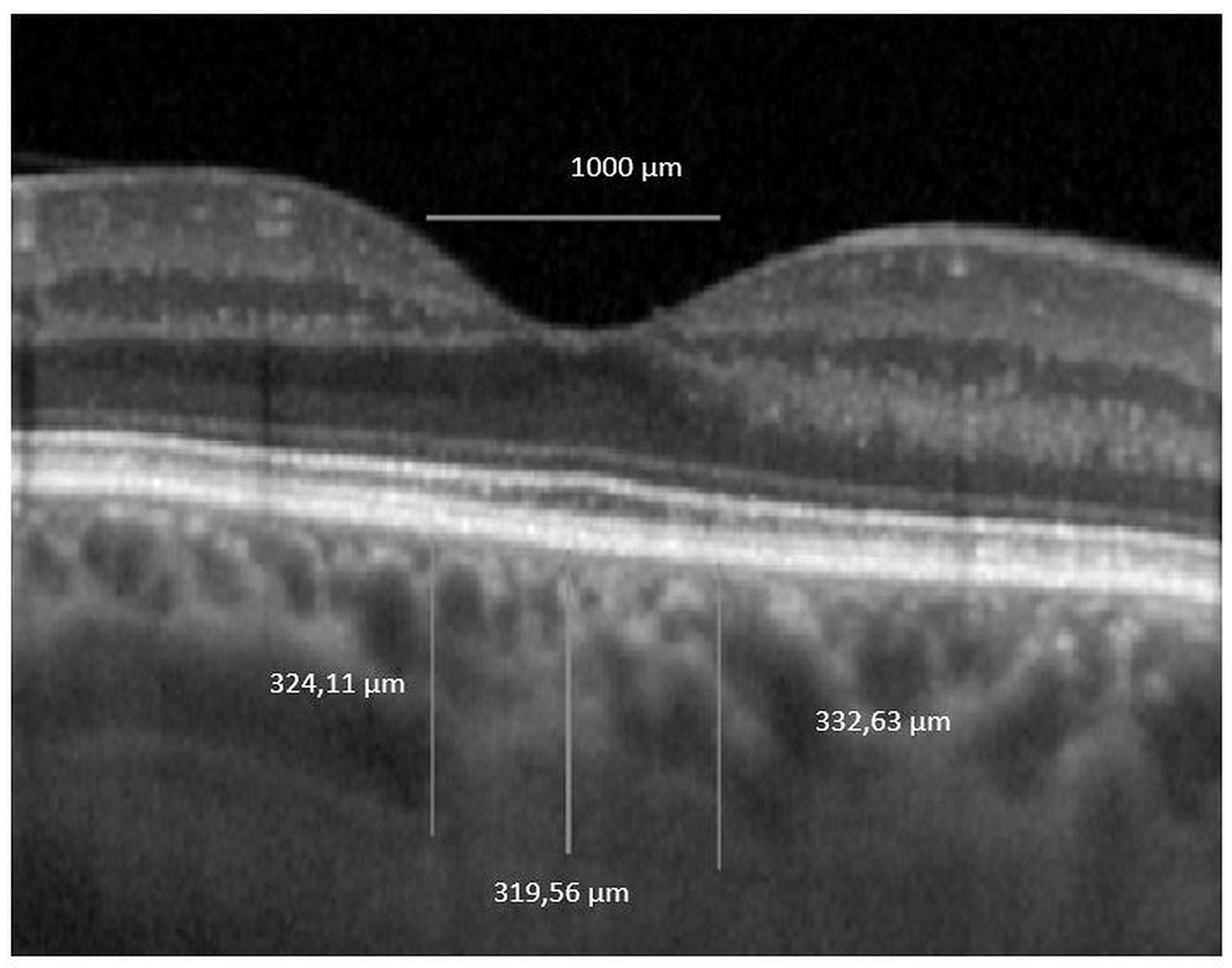 Jcm Free Full Text Analysis Of The Choroid And Its Relationship With The Outer Retina In Patients With Diabetes Mellitus Using Binarization Techniques Based On Spectral Domain Optical Coherence Tomography Html Jcm Free Full Text Analysis Of The Choroid And Its Relationship With The Outer Retina In Patients With Diabetes Mellitus Using Binarization Techniques Based On Spectral Domain Optical Coherence Tomography Html