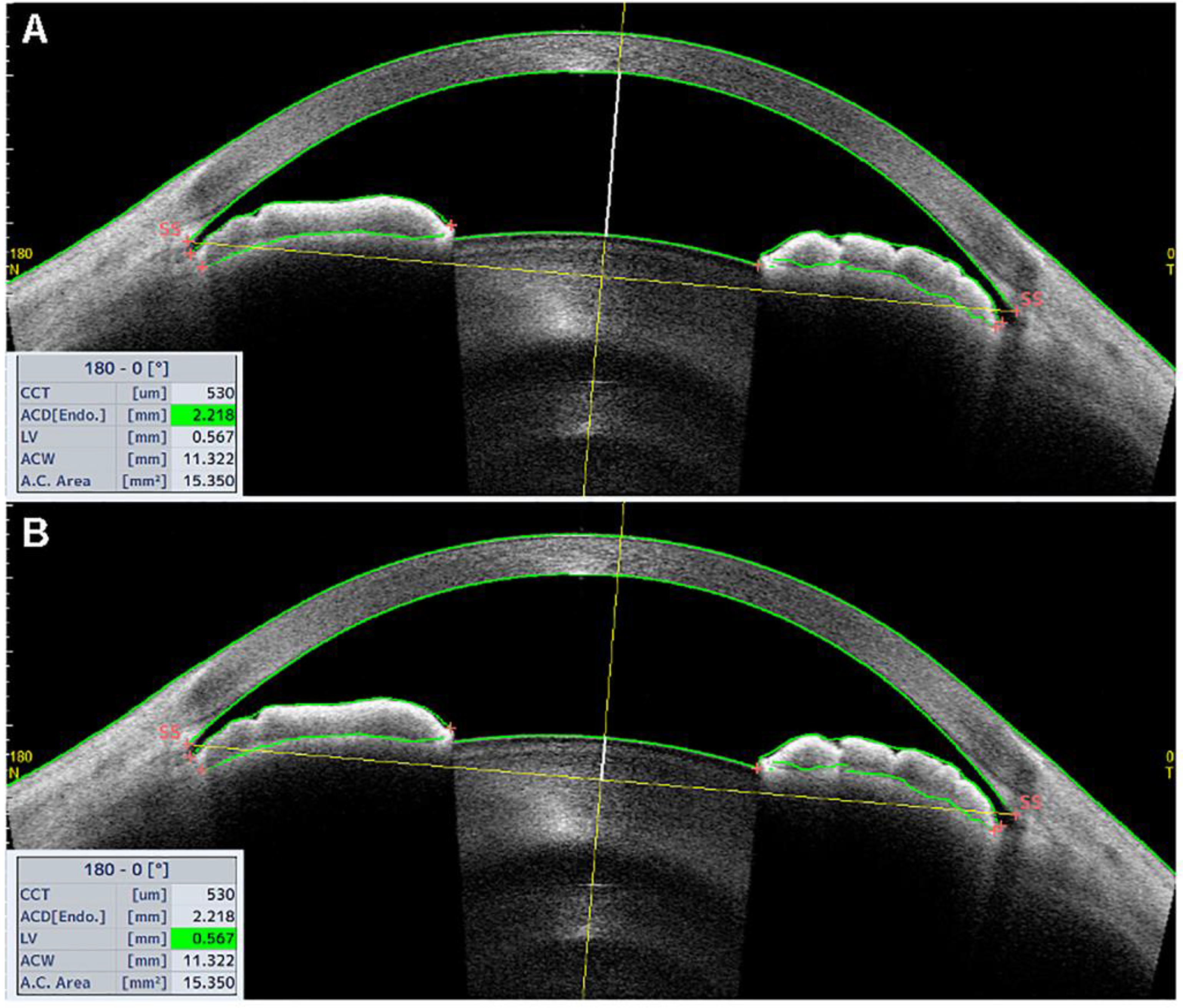 JCM | Free Full-Text | The Use of Anterior-Segment Optical-Coherence  Tomography for the Assessment of the Iridocorneal Angle and Its  Alterations: Update and Current Evidence
