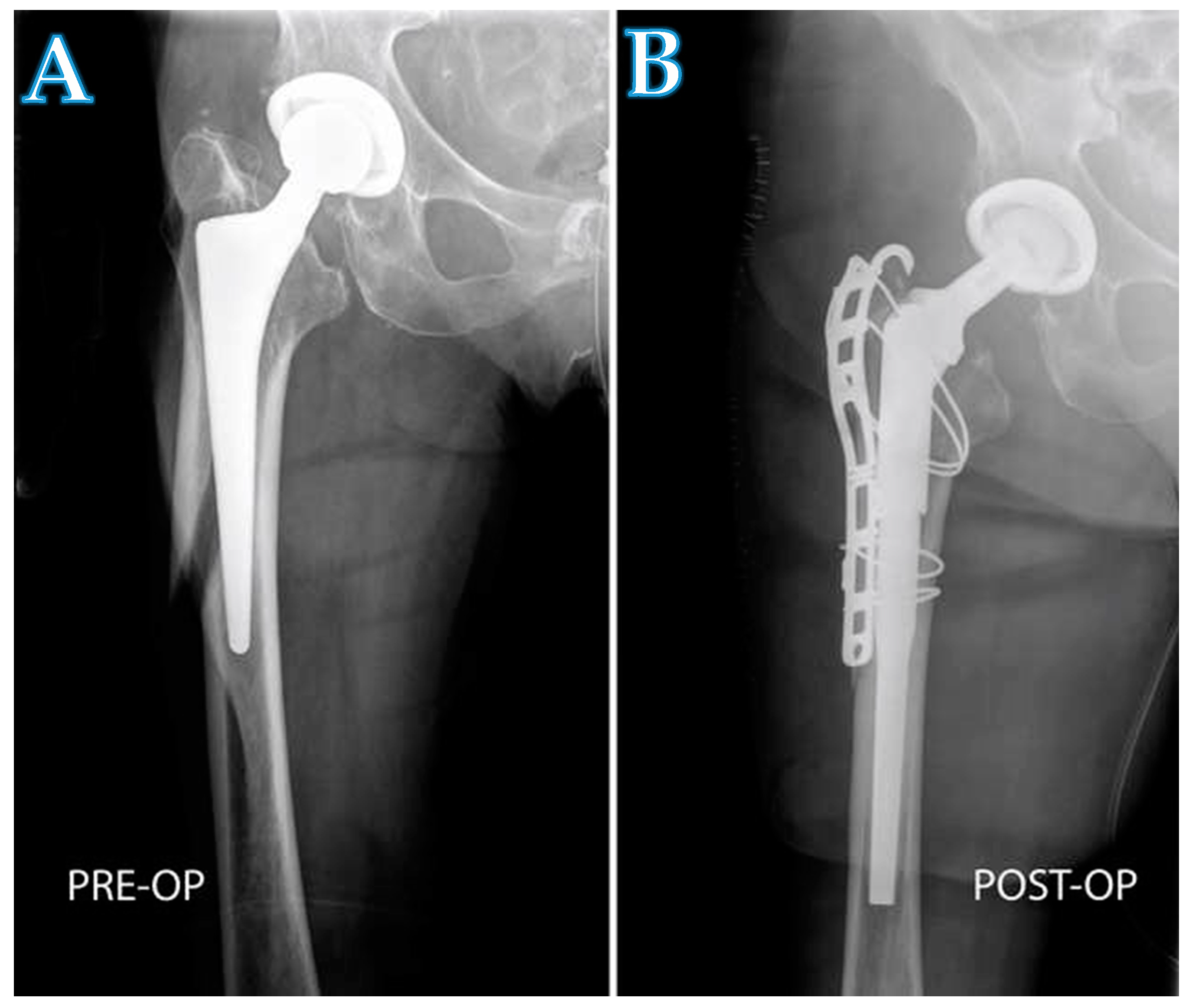 Jcm Free Full Text Femoral Revision Total Hip Arthroplasty