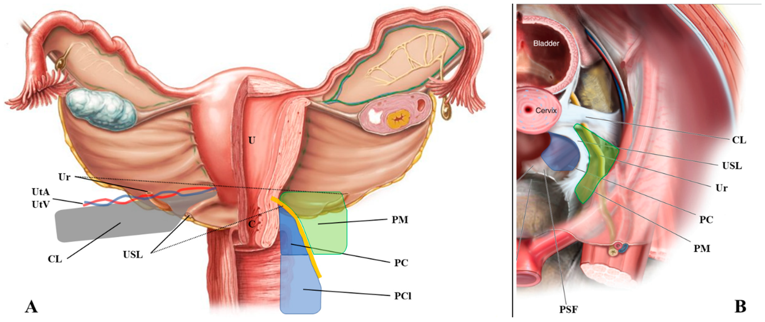 Jcm Free Full Text Ultrasound Of The Uterosacral Ligament Parametrium And Paracervix Disagreement In Terminology Between Imaging Anatomy And Modern Gynecologic Surgery Html