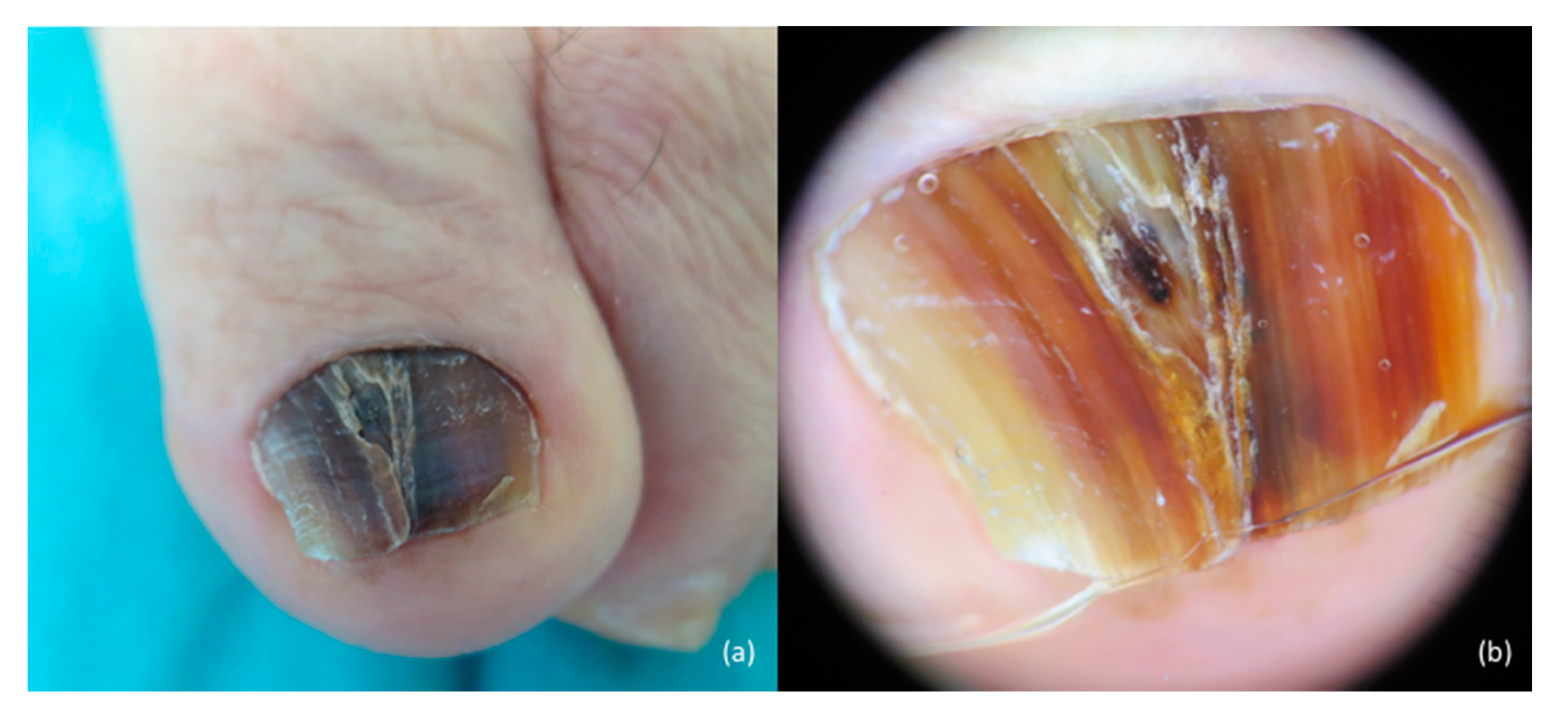 PDF) Exogenous nail pigmentation secondary to pecan nuts (Carya  illinoinensis)