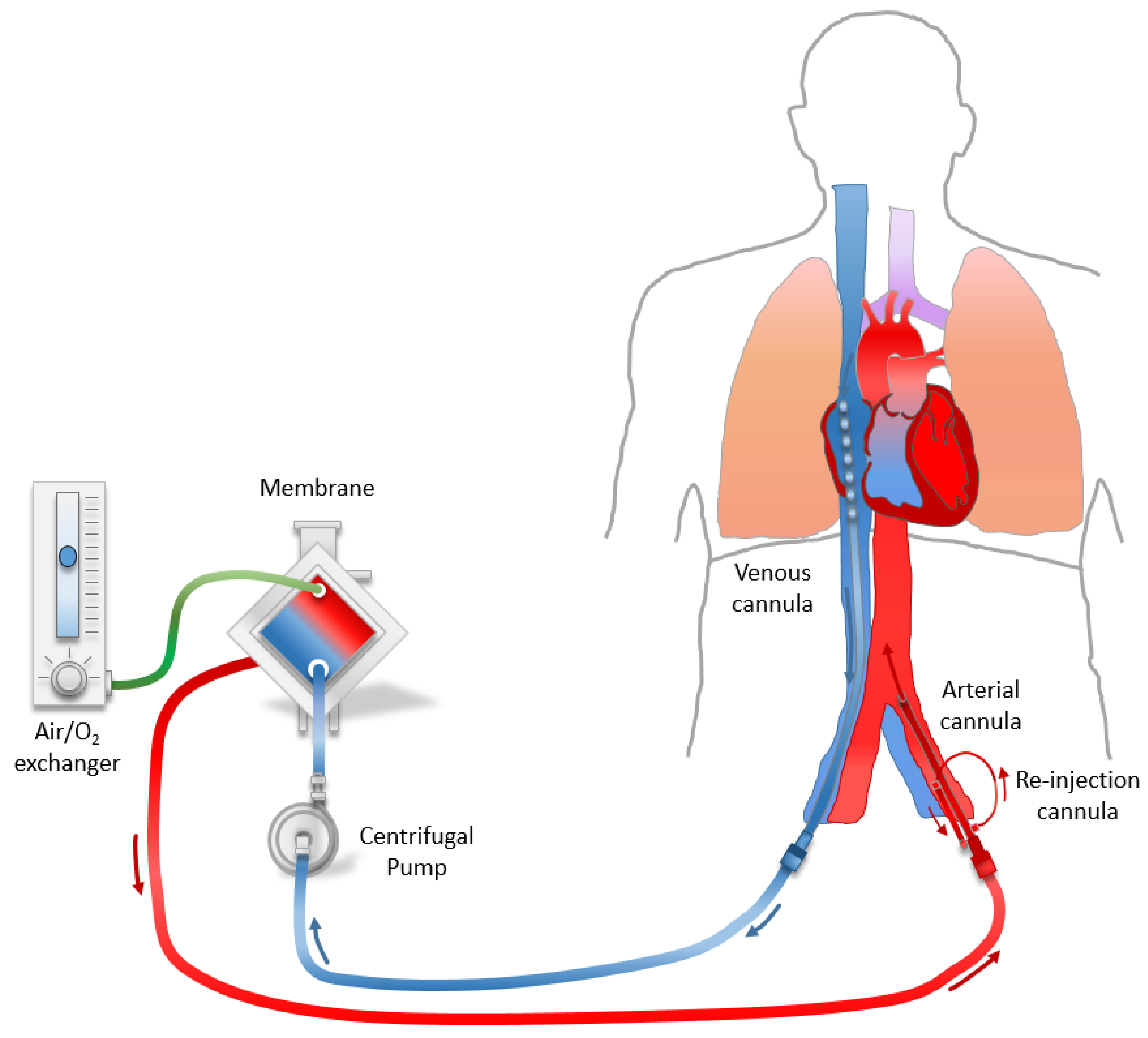 Ecmo what is VA ECMO