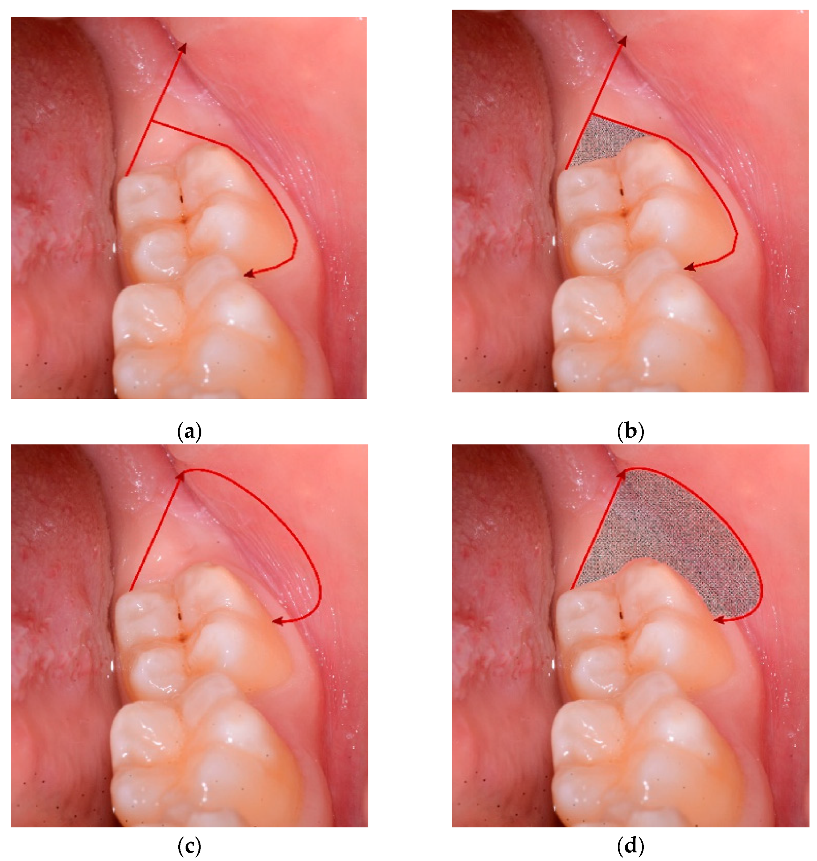 JCM | Free Full-Text | Flapless Surgical Approach to Extract Impacted  Inferior Third Molars: A Retrospective Clinical Study