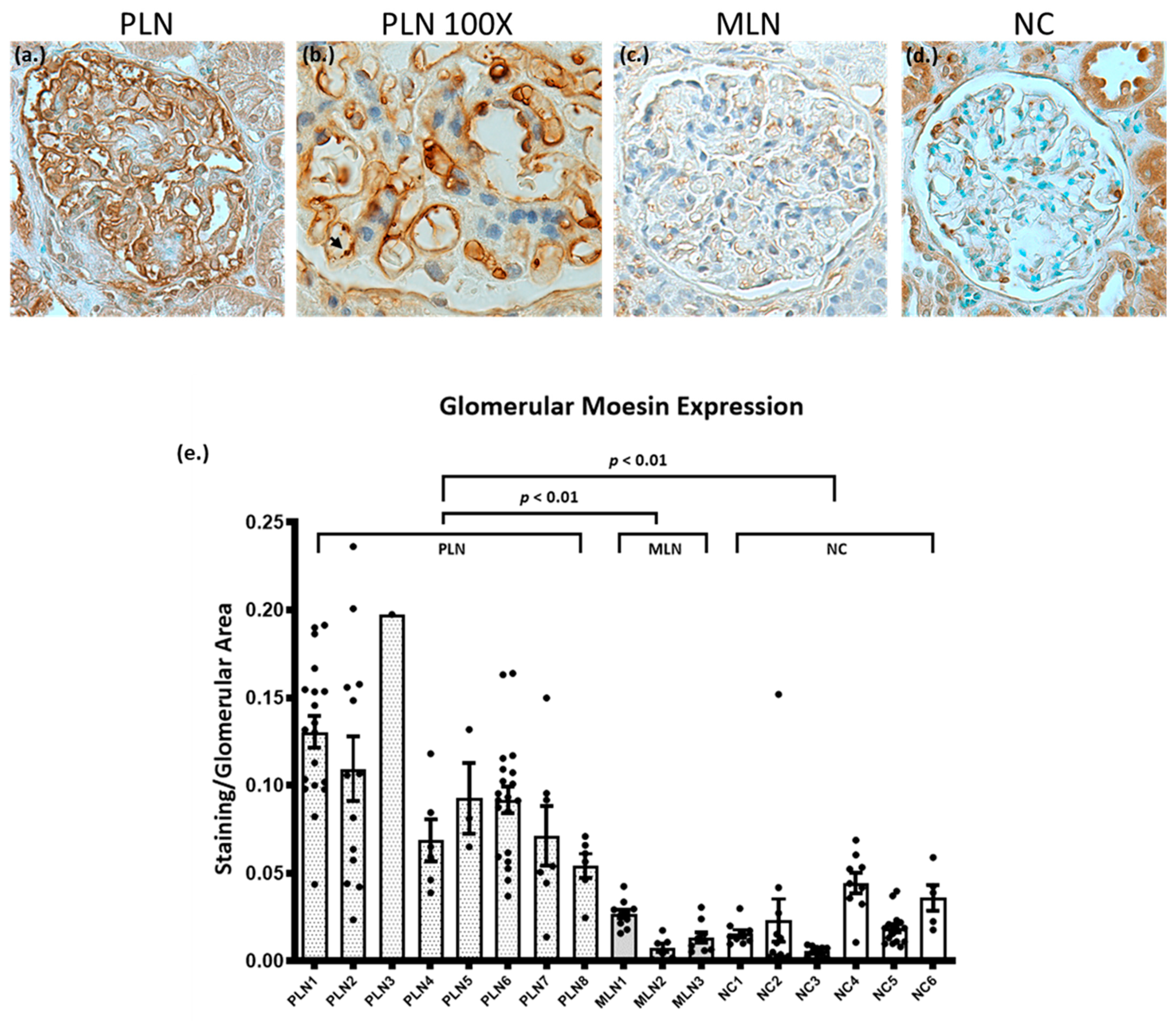 JCM  Free Full-Text  Patients with Proliferative Lupus Nephritis 