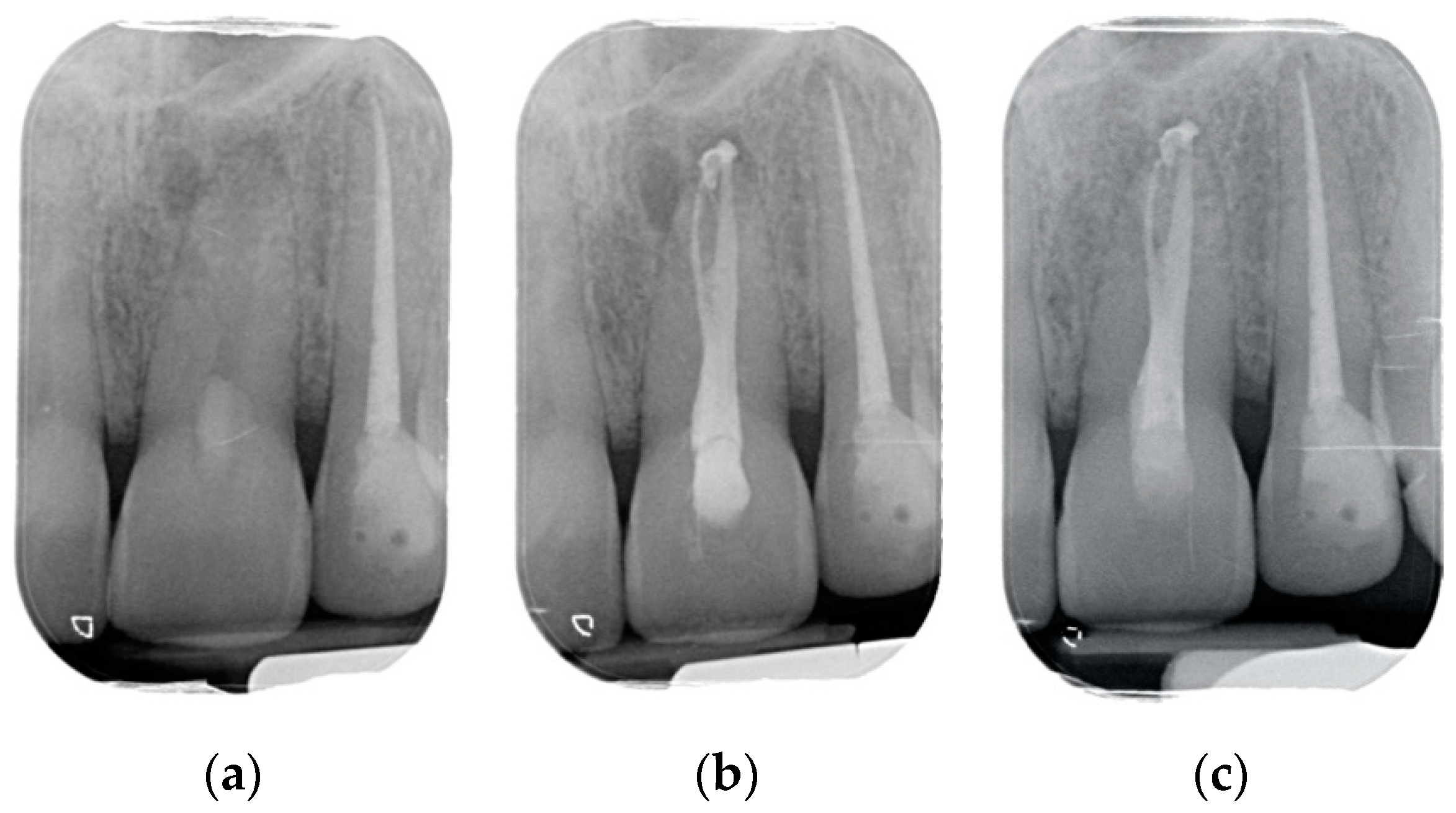 Clinical Outcomes of Endodontic Treatments and Restorations