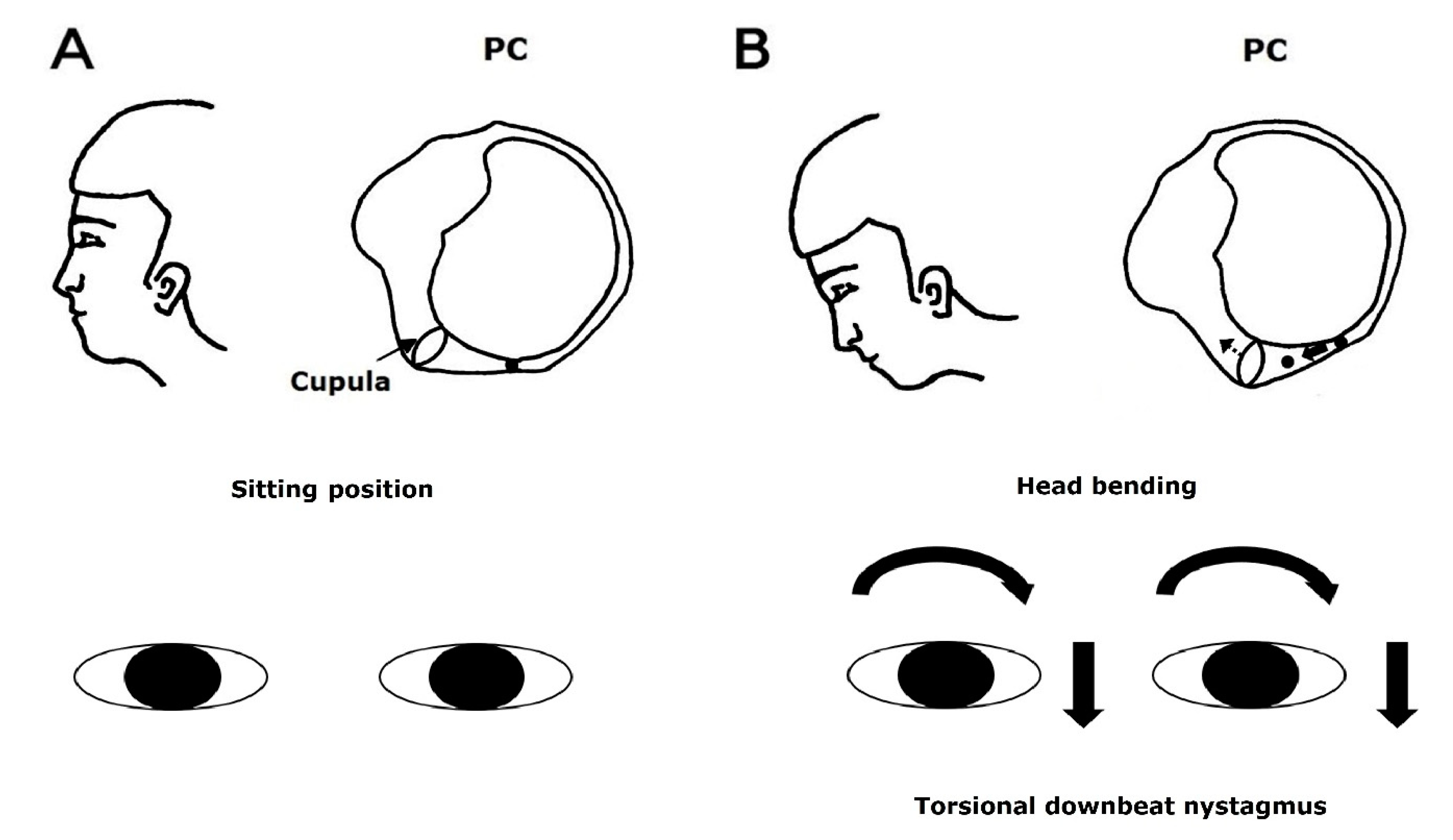 JCM Free FullText HeadShaking Nystagmus in Posterior Canal Benign