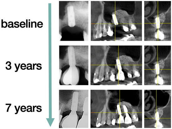 Short (6 mm) and Regular Dental Implants in the Posterior Maxilla