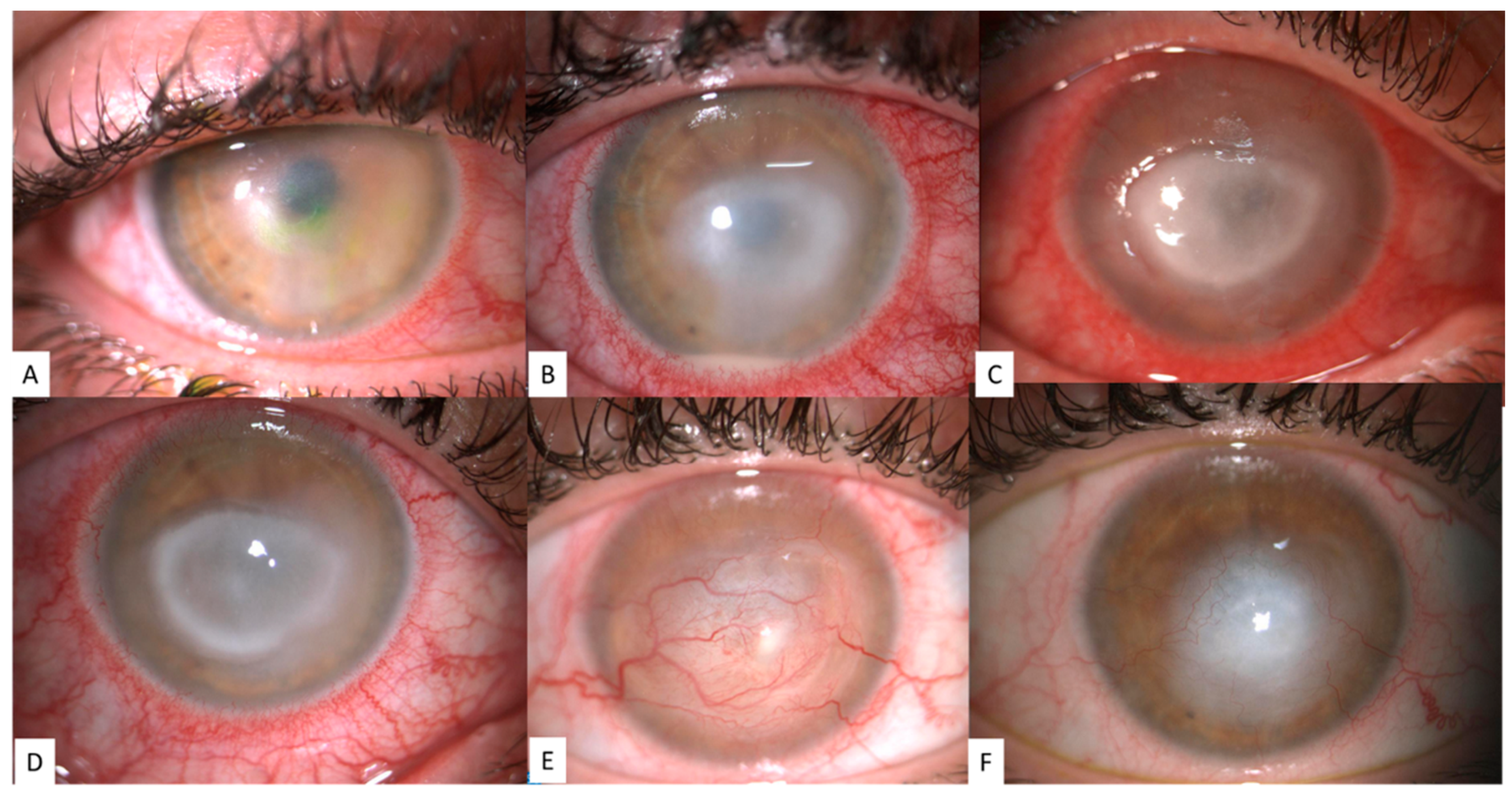 JCM | Free Full-Text | Challenges in Acanthamoeba Keratitis: A Review