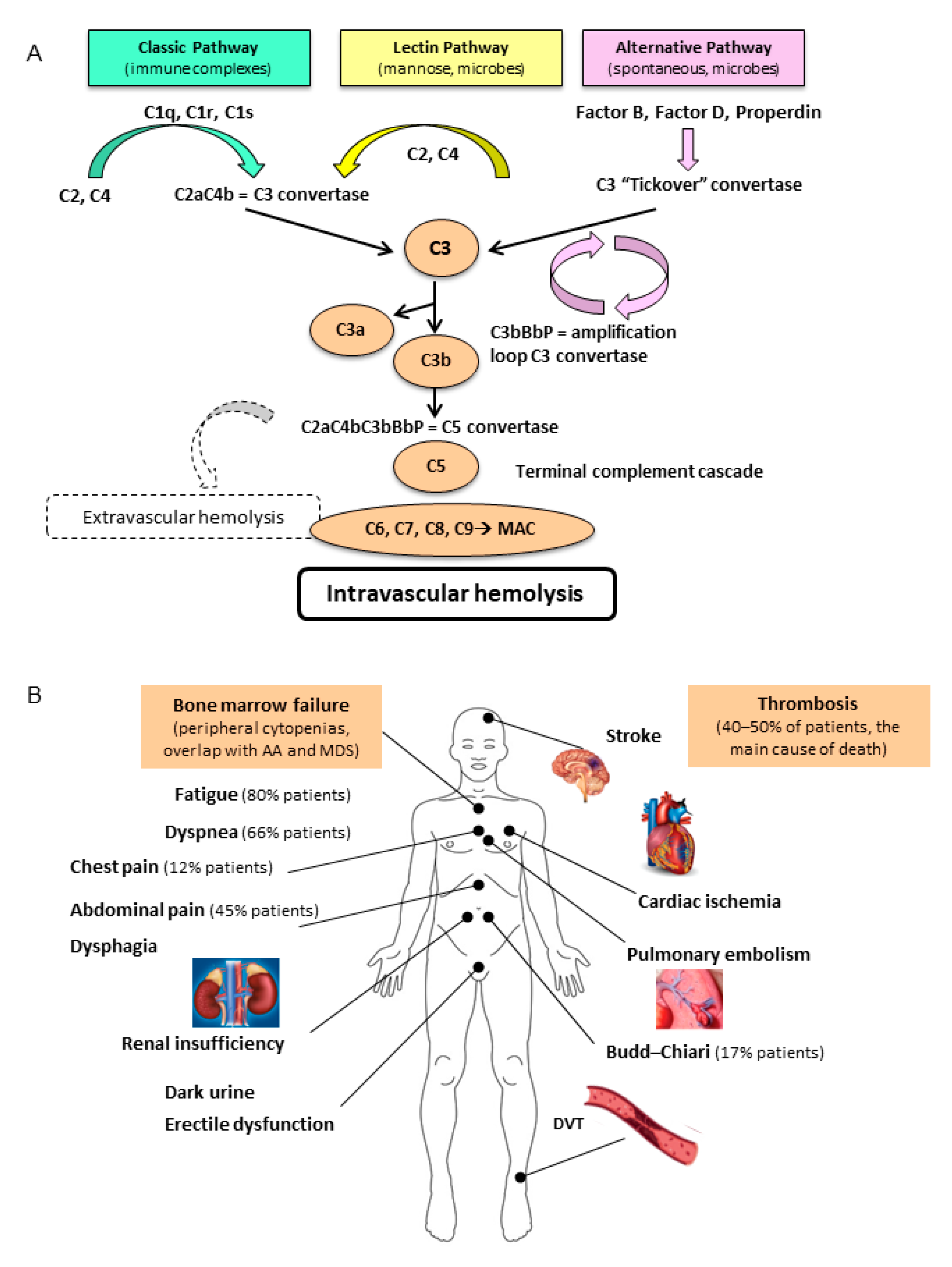 JCM | Free Full-Text | Difficult Cases of Paroxysmal Nocturnal Hemoglobinuria: and Therapeutic Novelties