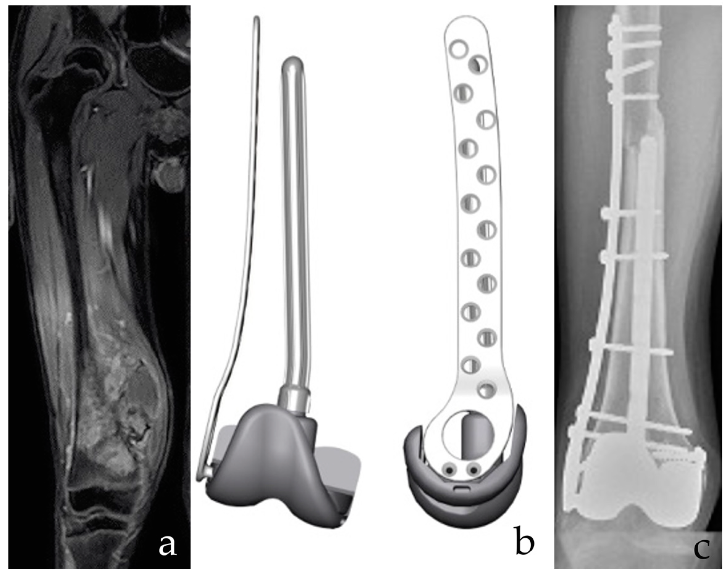 Custom-Made 3D-Printed Implants as Novel Approach to Custom-Made 3D-Printed Implants as Novel Approach to