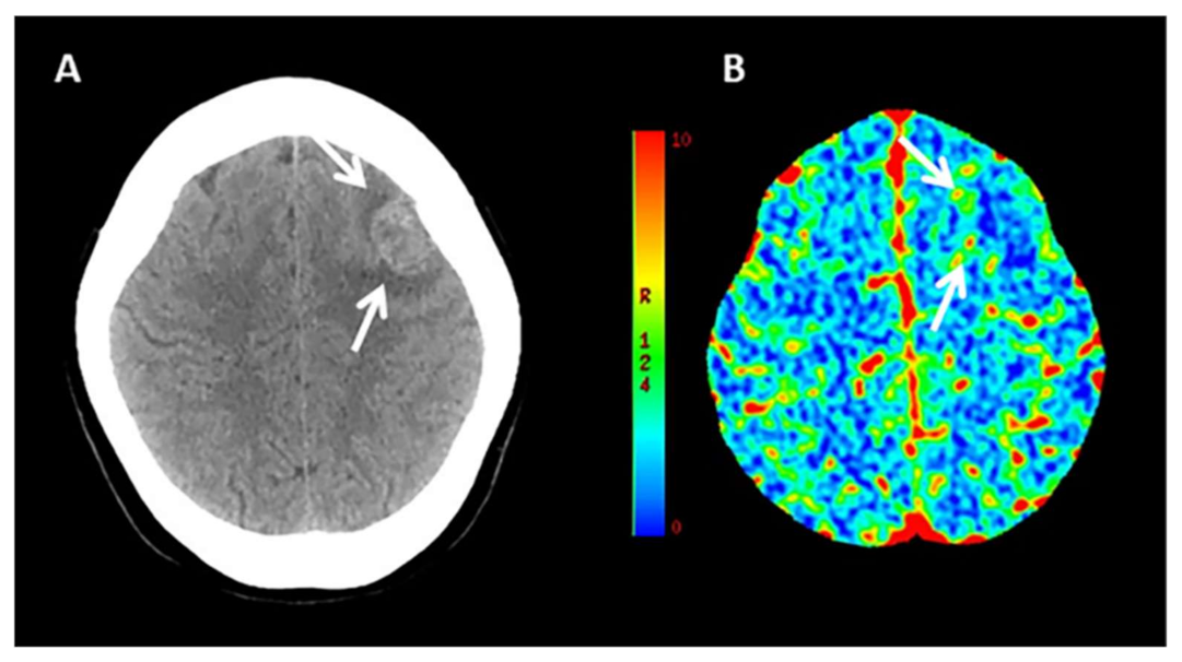 Neuroimaging of Acute Intracerebral Hemorrhage