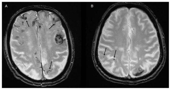 Frontiers | Neuro-imaging in intracerebral hemorrhage