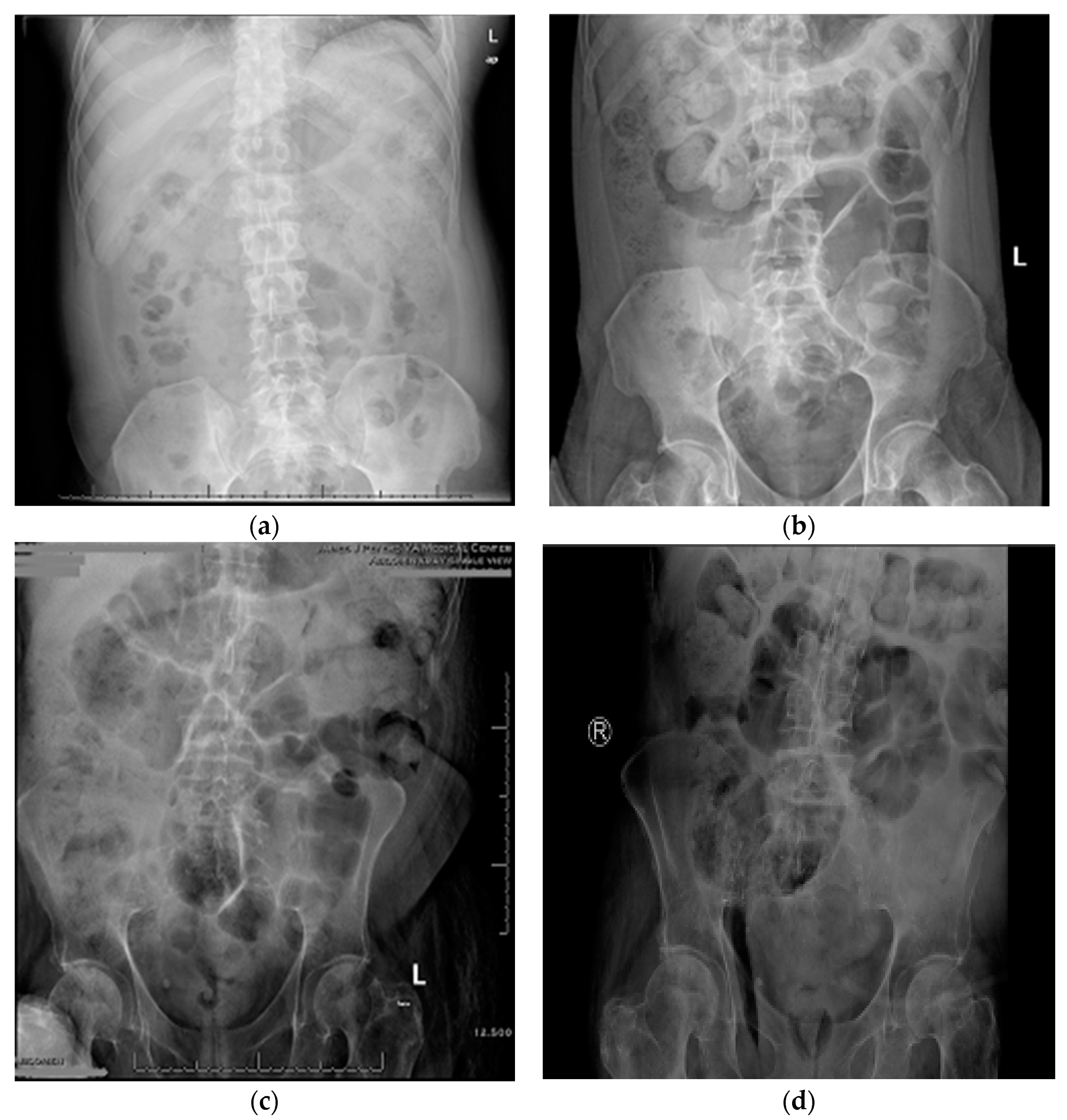 Is Moderate Colonic Stool Burden A Sign Of Something Worse? - uwbbm03