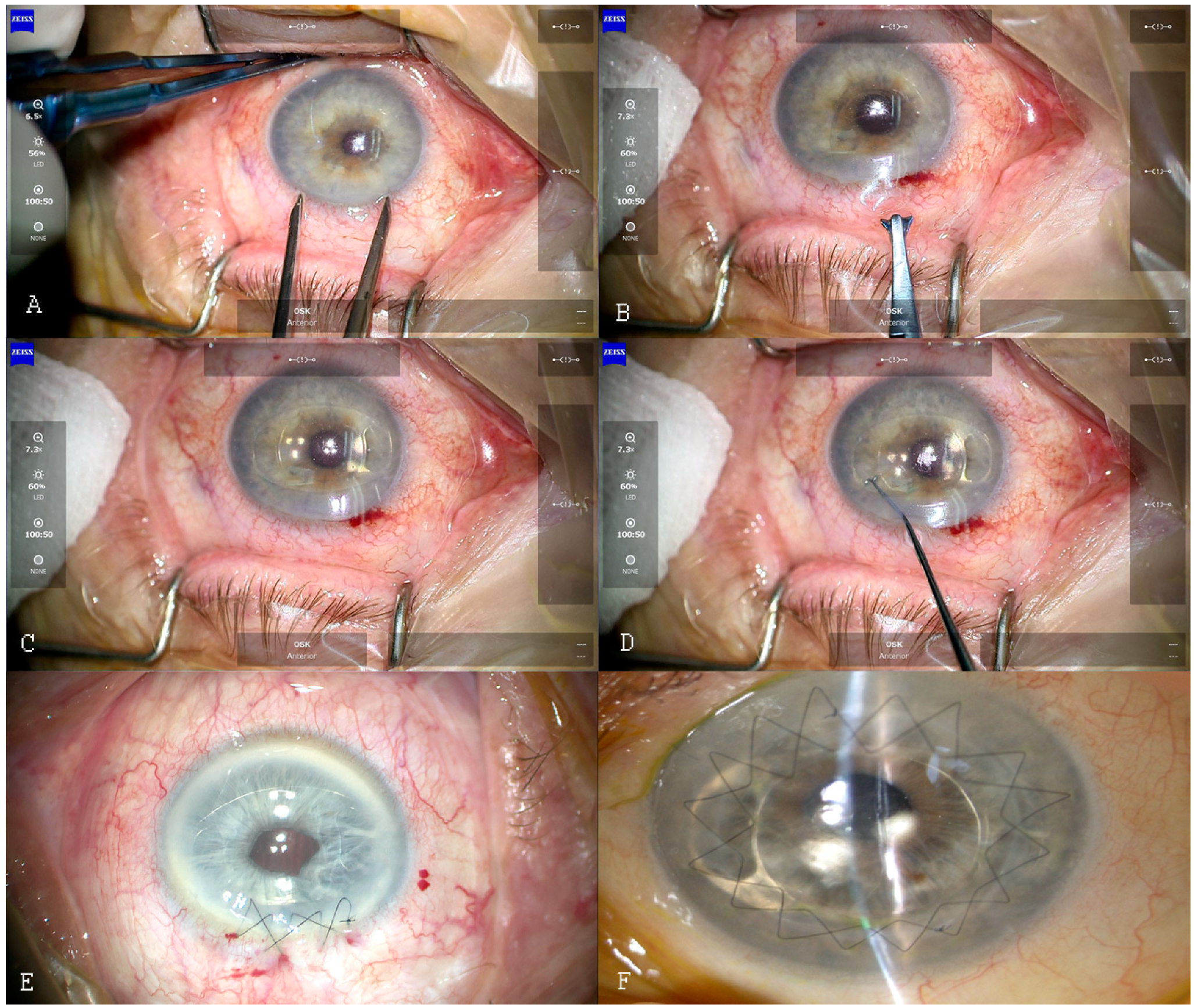 Geleerde tanker Officier JCM | Free Full-Text | Iris-Claw Intraocular Lens Implantation in Various  Clinical Indications: A 4-Year Study