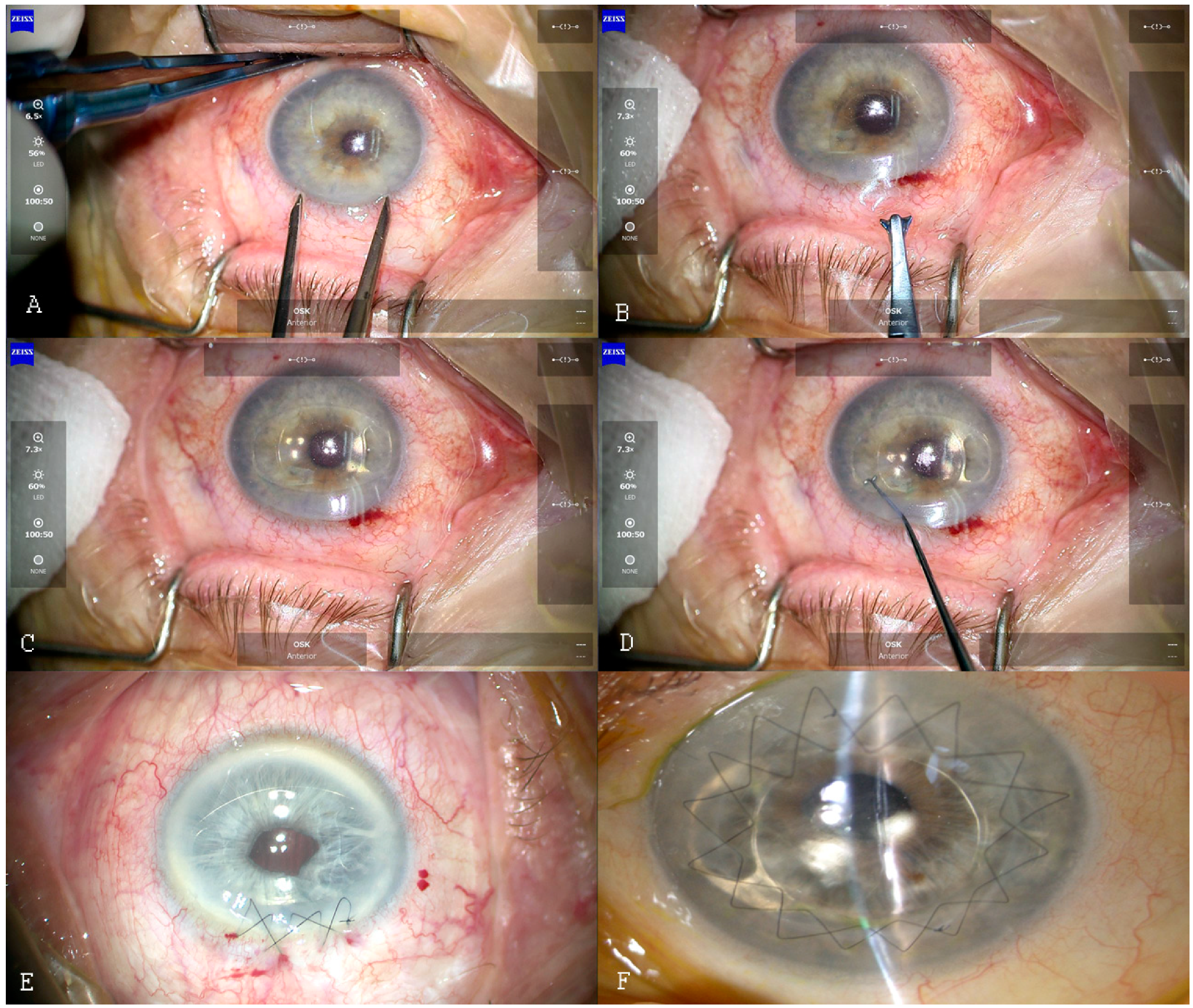Geleerde tanker Officier JCM | Free Full-Text | Iris-Claw Intraocular Lens Implantation in Various Clinical Indications: A 4-Year Study Geleerde tanker Officier JCM | Free Full-Text | Iris-Claw Intraocular Lens Implantation in Various Clinical Indications: A 4-Year Study