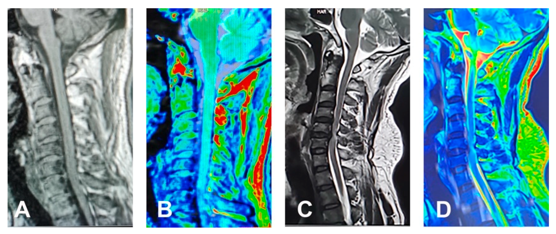 Assessment of degenerative cervical stenosis on T2-weighted MR imaging:  sensitivity to change and reliability of mid-sagittal and axial plane  metrics