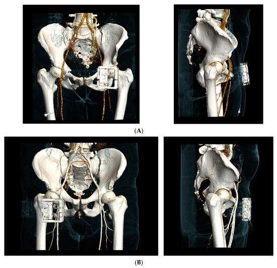 専用！！骨盤骨折 = Fractures of the pelvis and 骨盤骨折 = Fractures of the pelvis and acet…