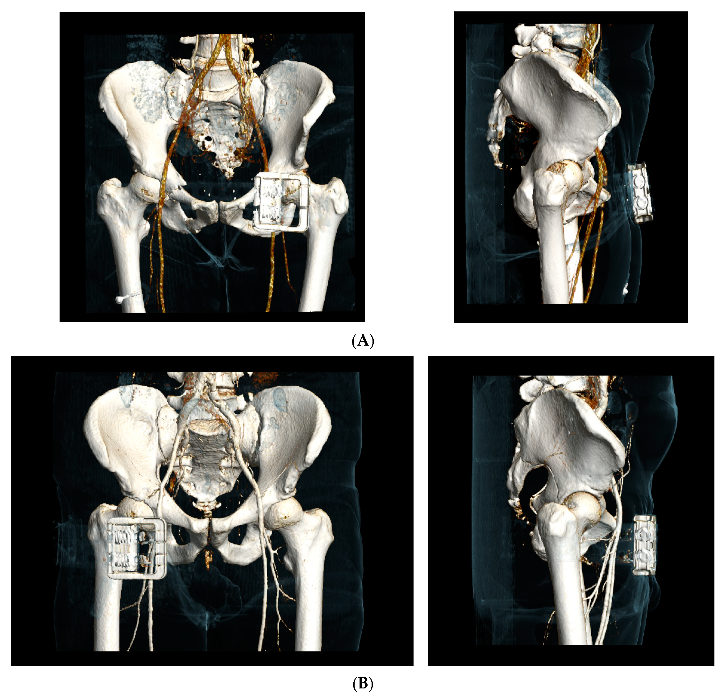 専用！！骨盤骨折 = Fractures of the pelvis and 1024px-